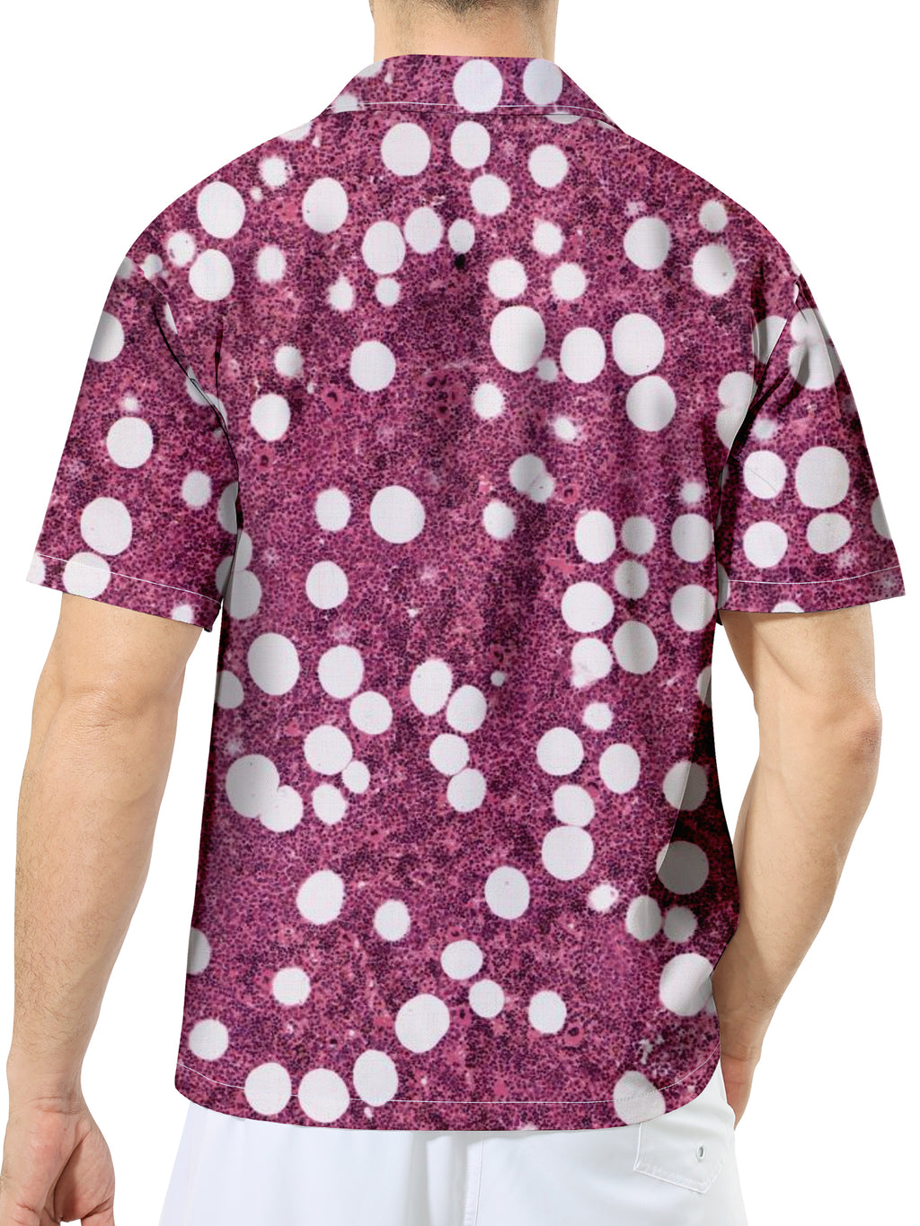 Adrenales Myelolipom Hemd