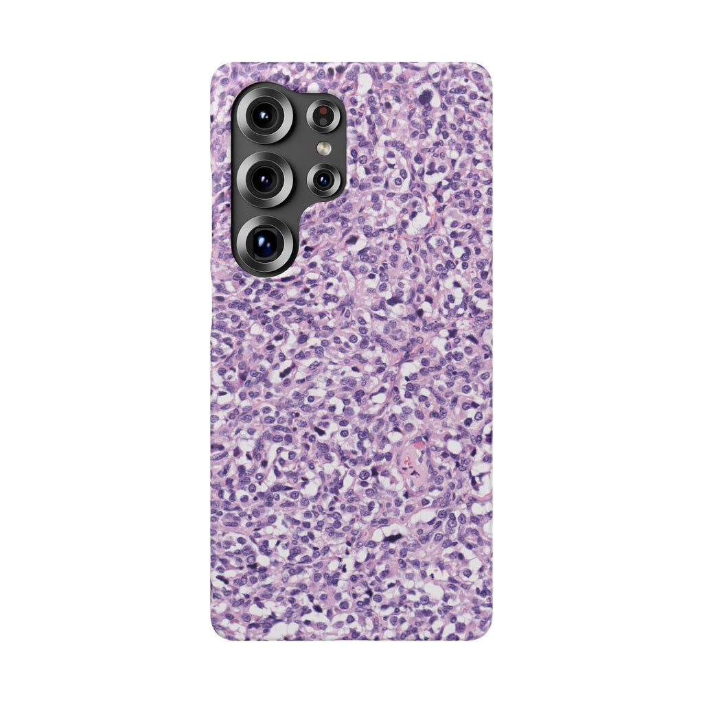 Slim Case Paraganglion