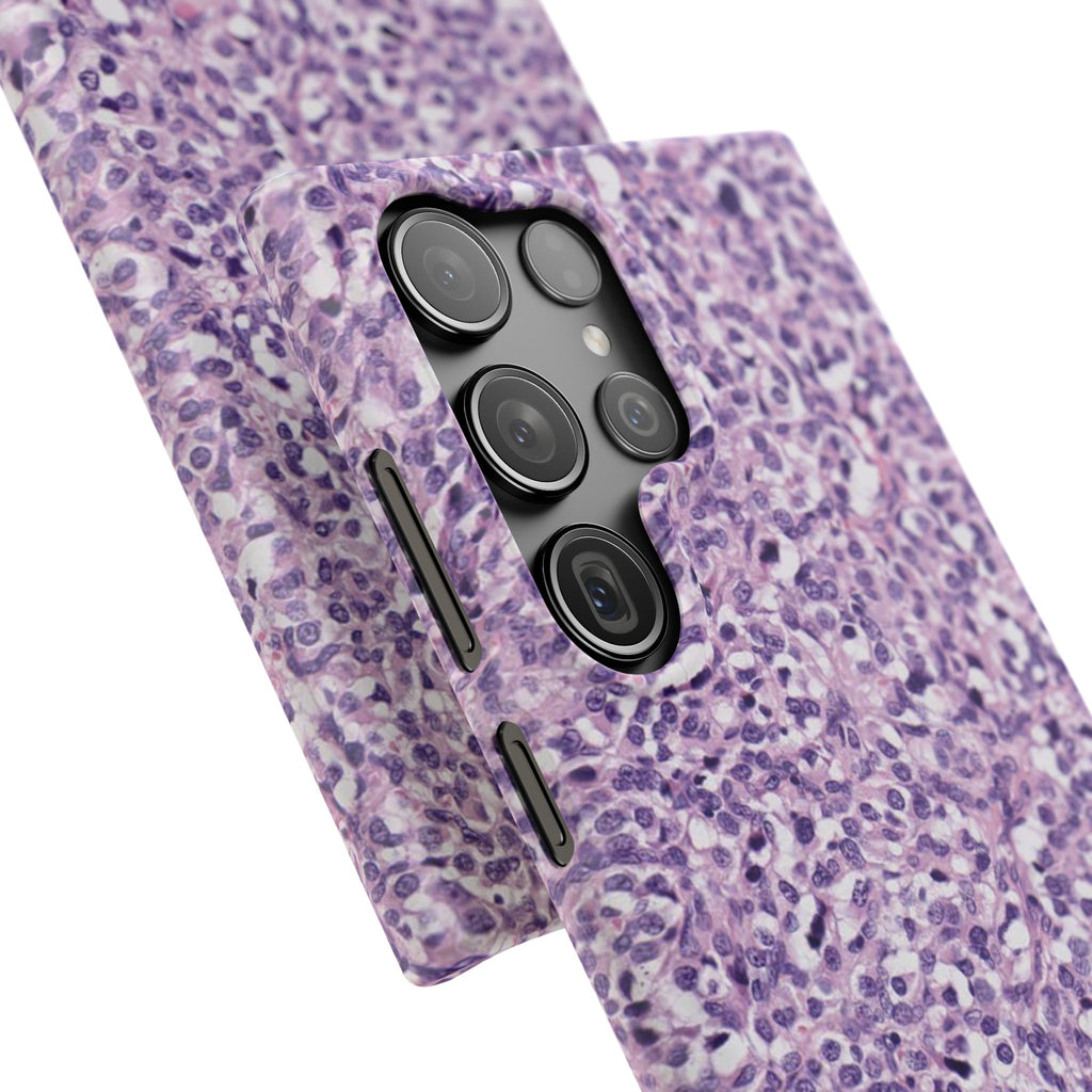 Slim Case Paraganglion