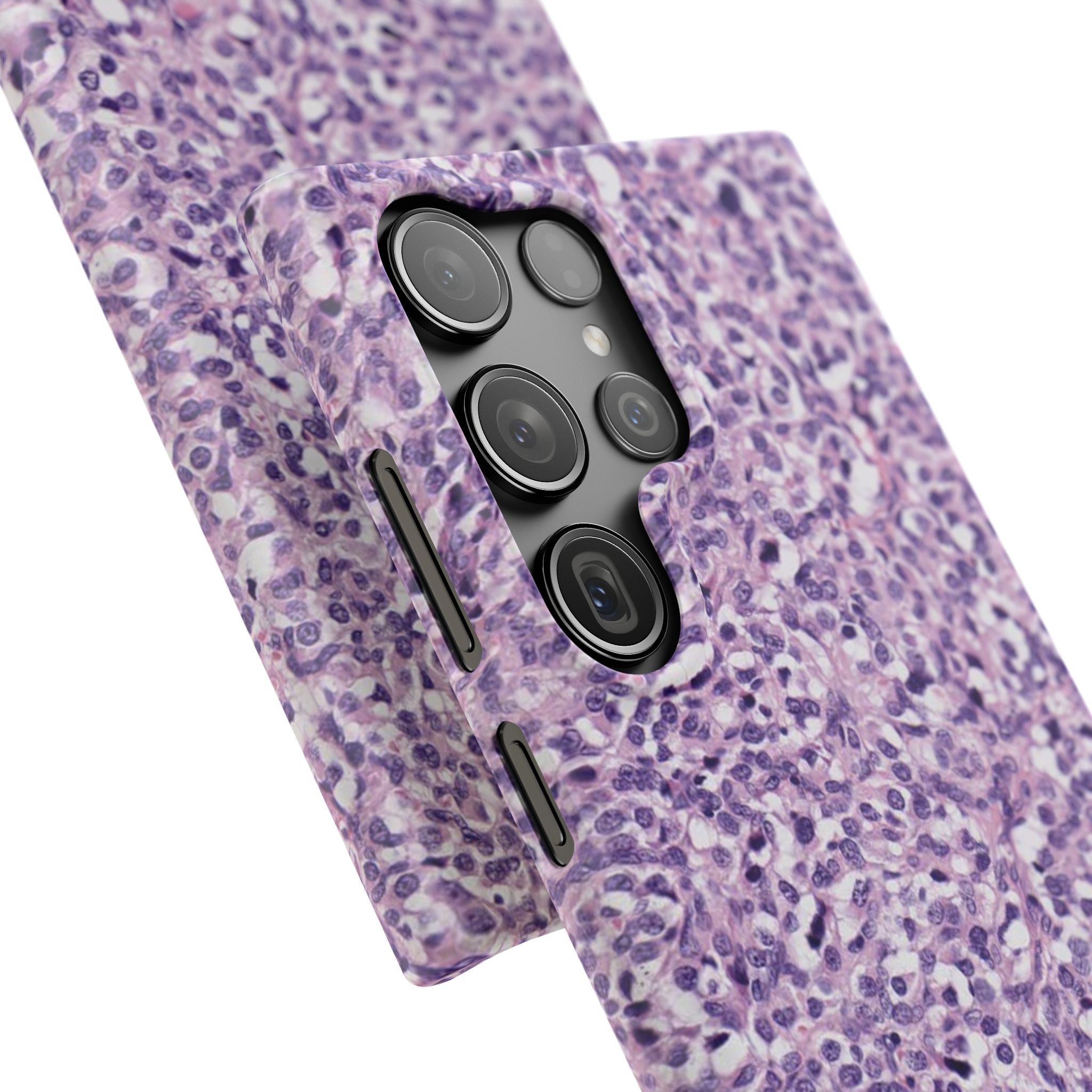 Slim Case Paraganglion