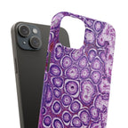 Slim Case Peutz-Jeghers Polyp