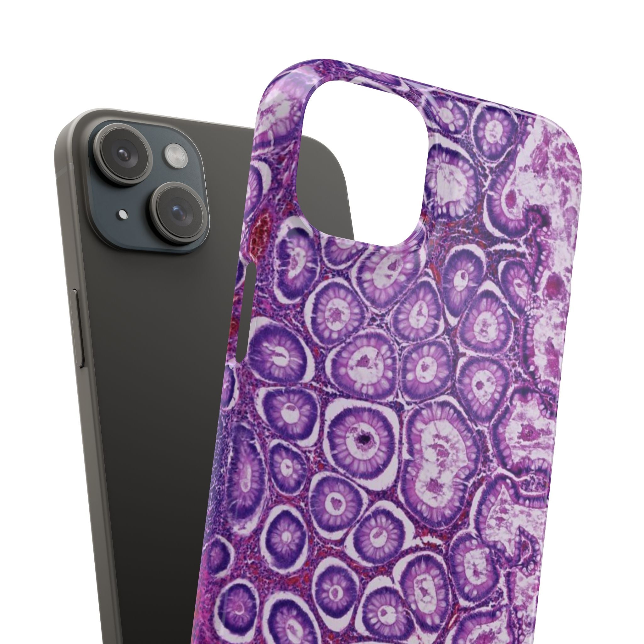 Slim Case Peutz-Jeghers Polyp