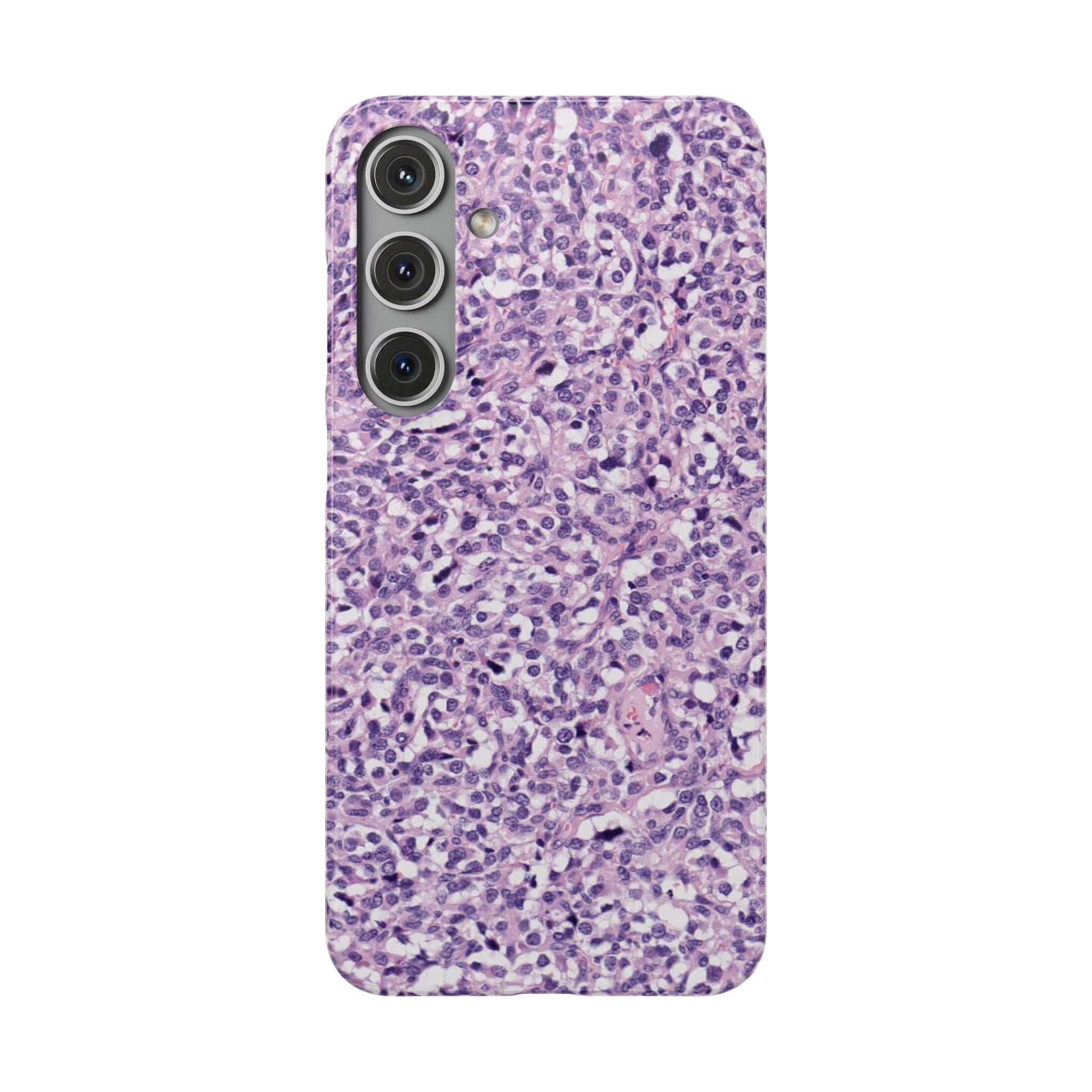 Slim Case Paraganglion