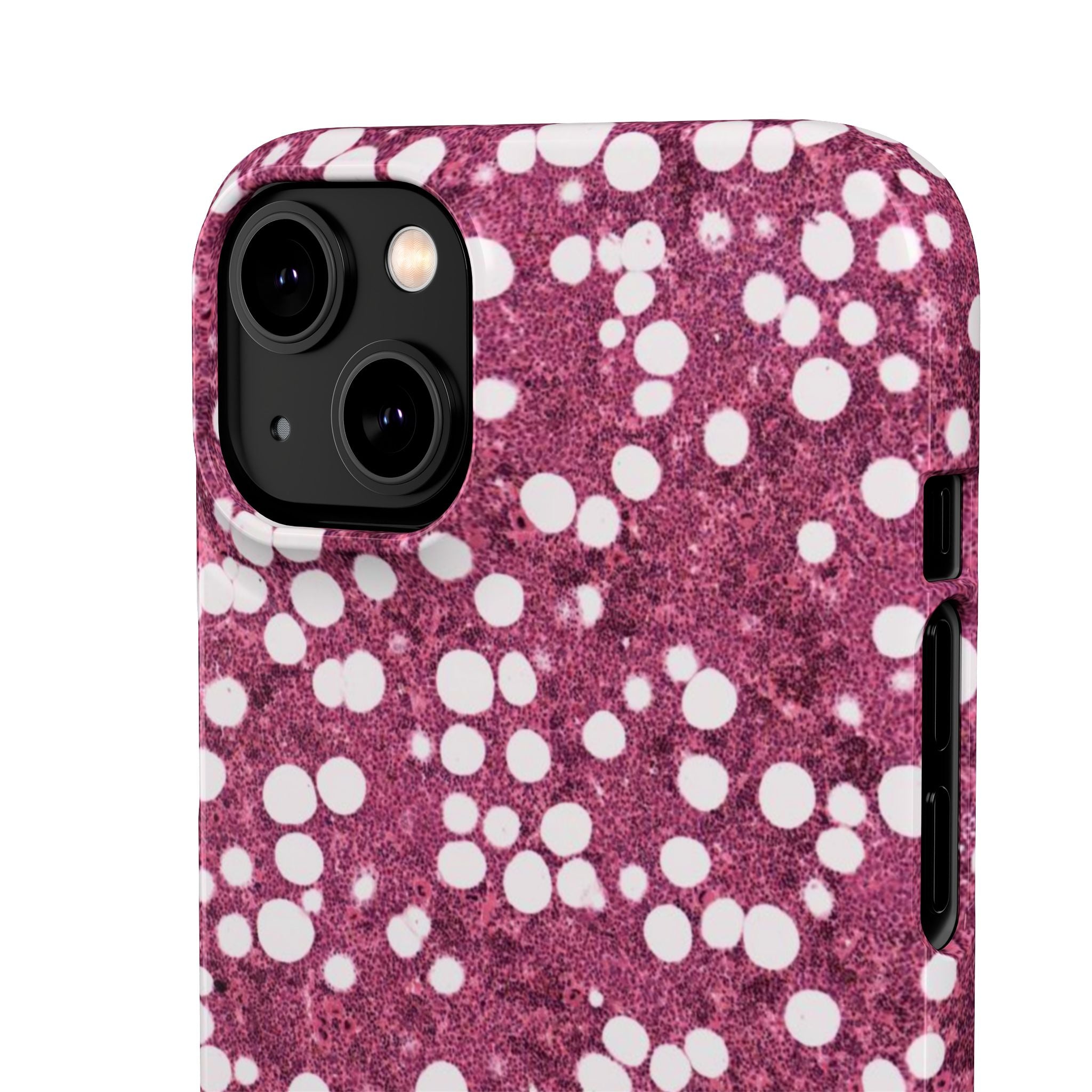 Slim Case Myelolipom