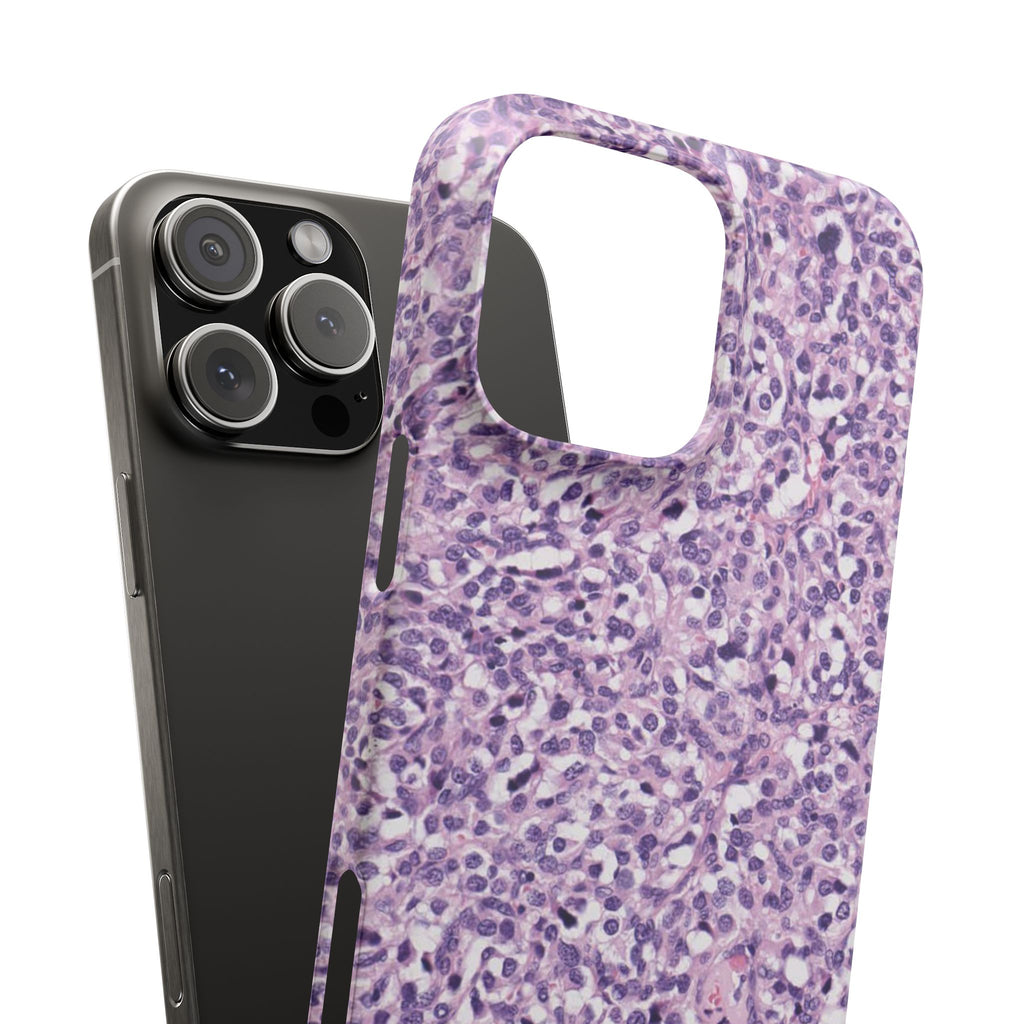 Slim Case Paraganglion