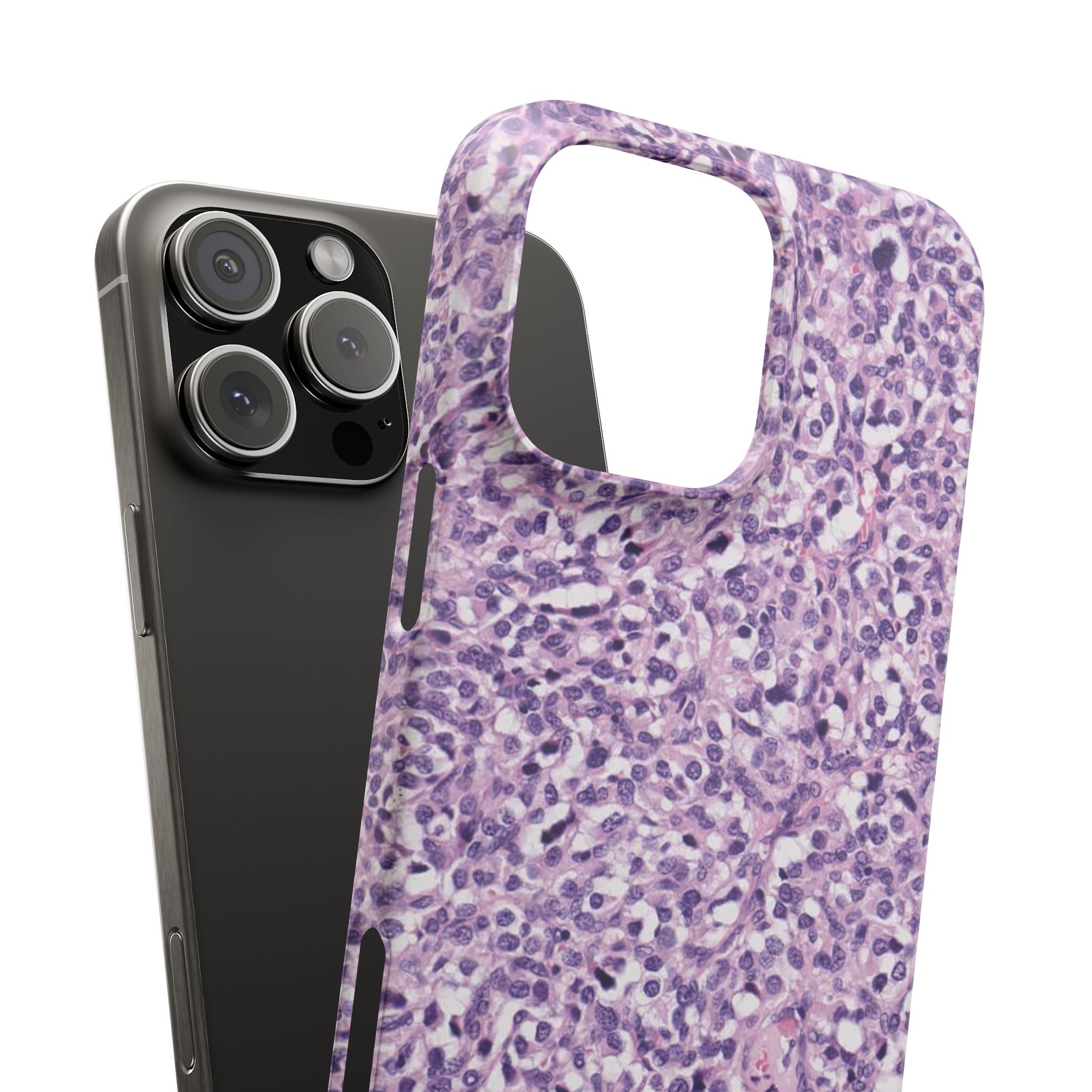 Slim Case Paraganglion