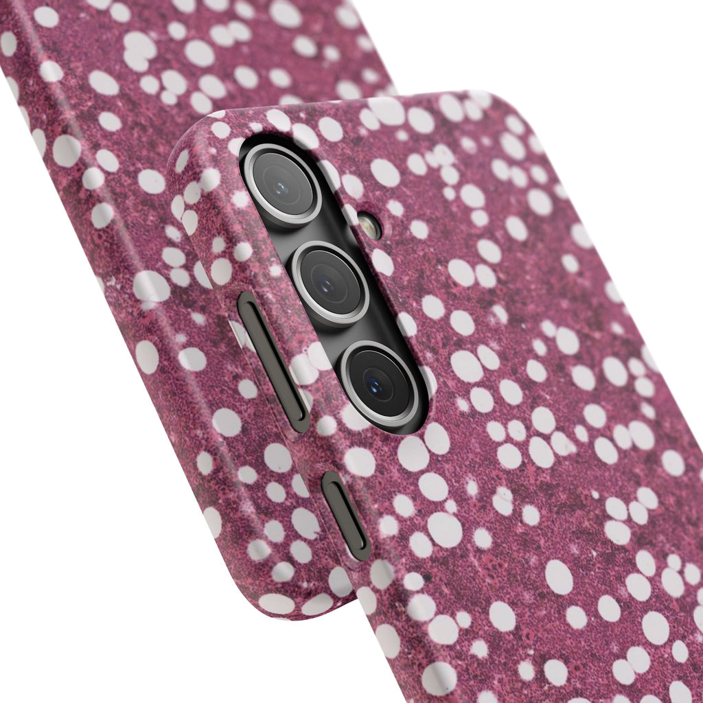 Slim Case Myelolipom