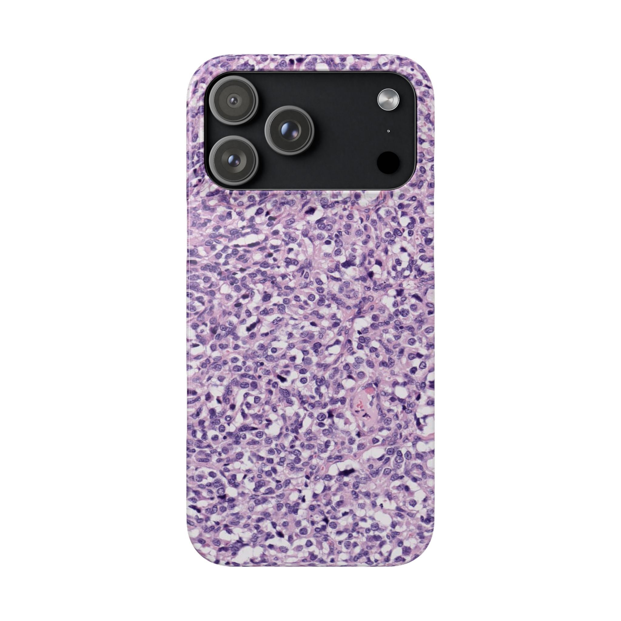 Slim Case Paraganglion