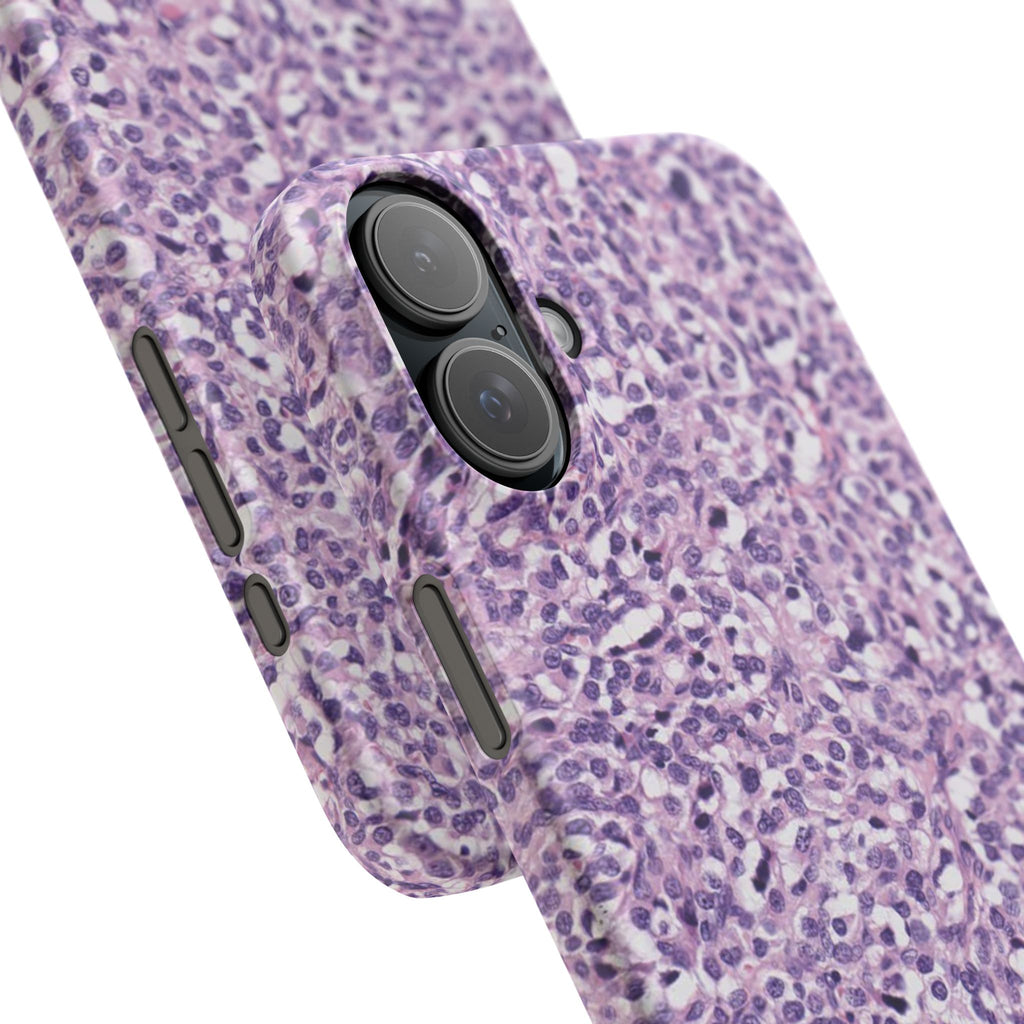 Slim Case Paraganglion