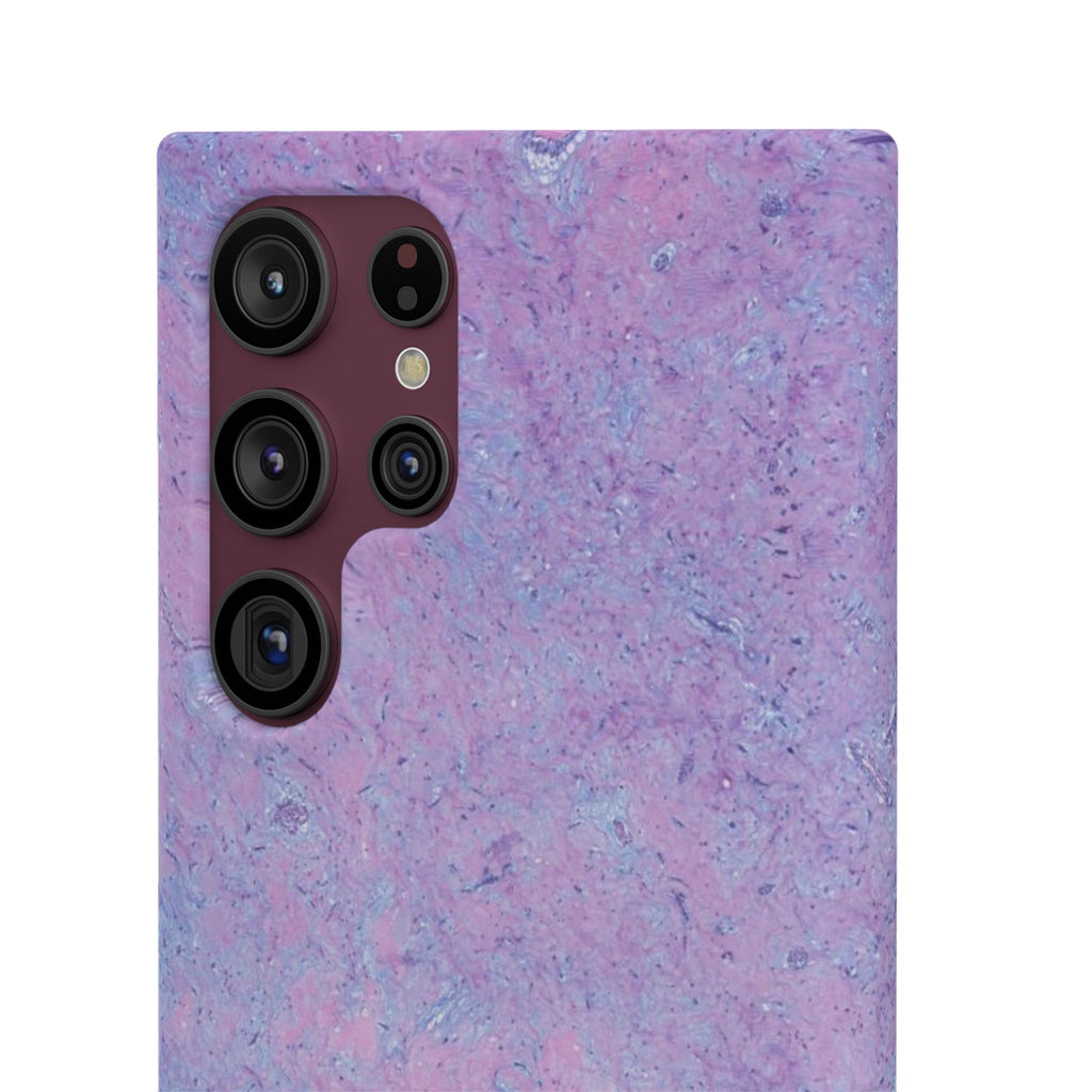 Slim Case Arterielles Myxom