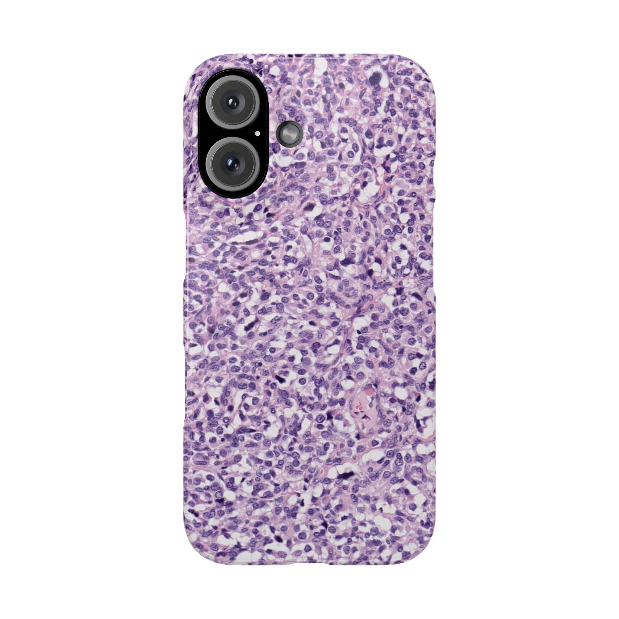 Slim Case Paraganglion