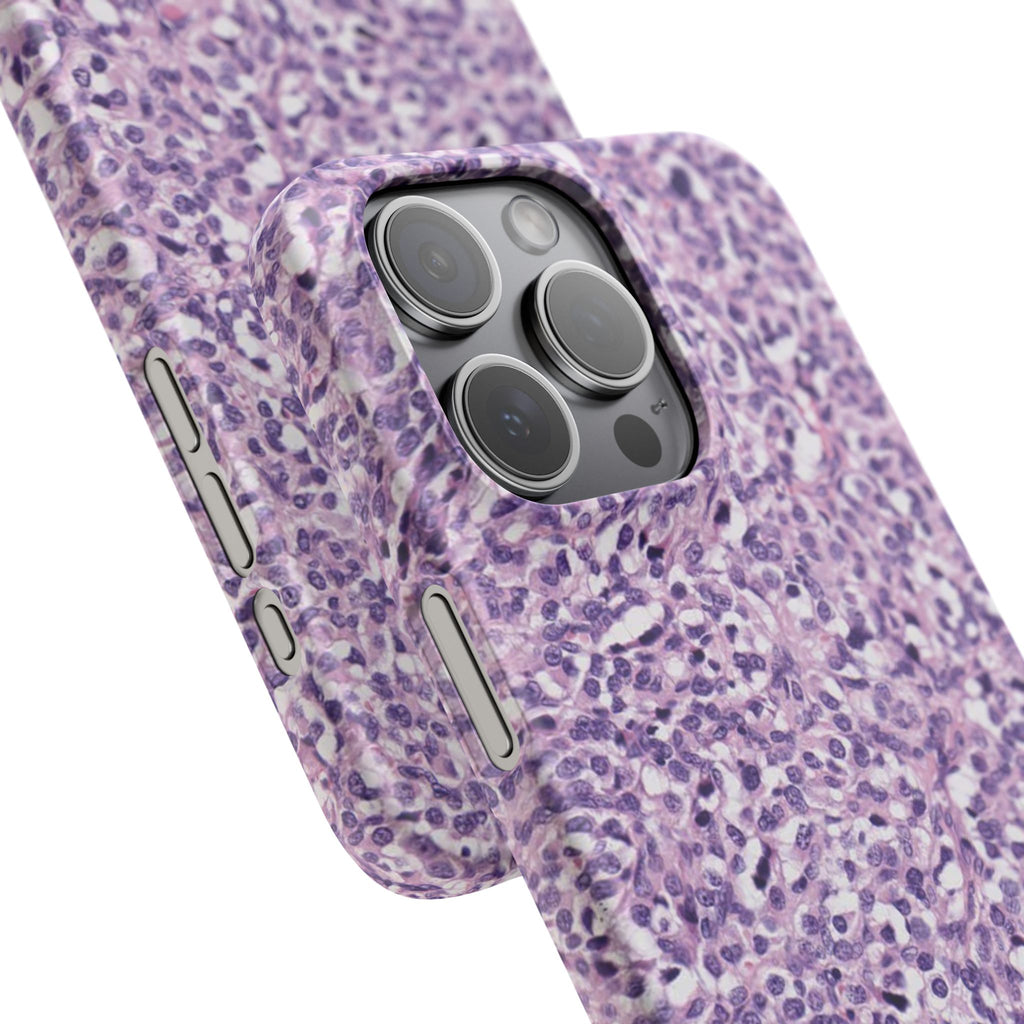 Slim Case Paraganglion