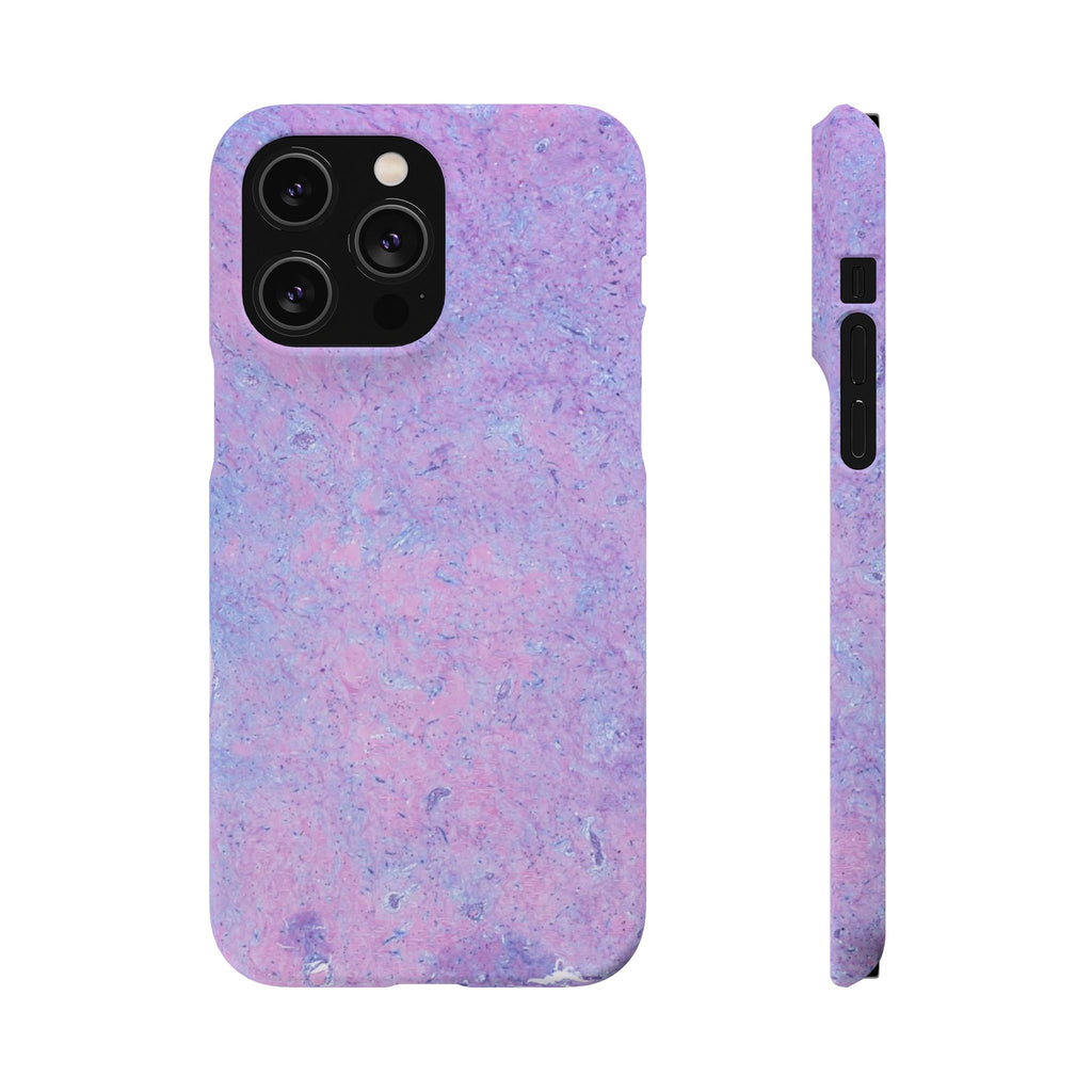 Slim Case Arterielles Myxom