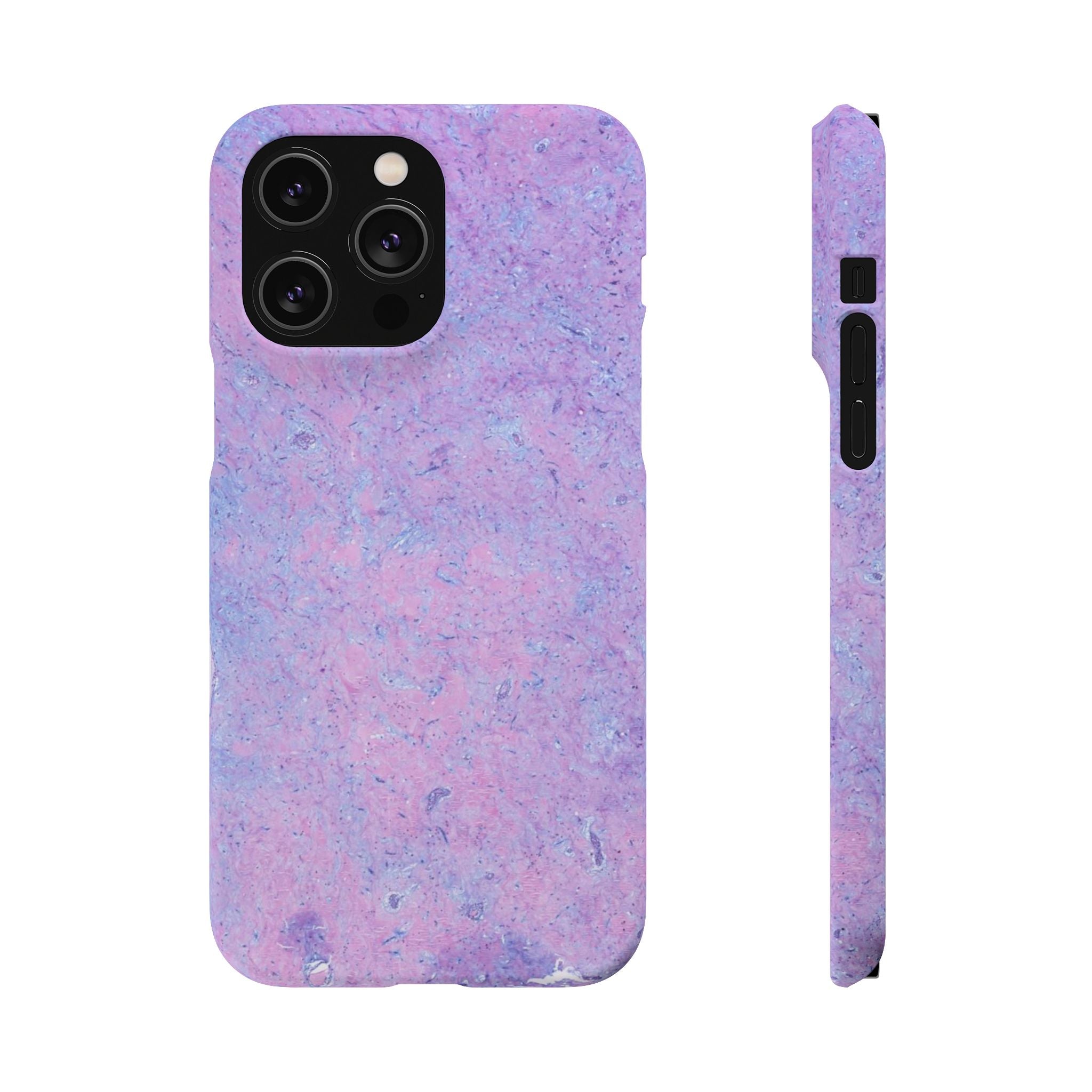 Slim Case Arterielles Myxom