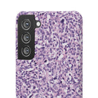 Slim Case Paraganglion