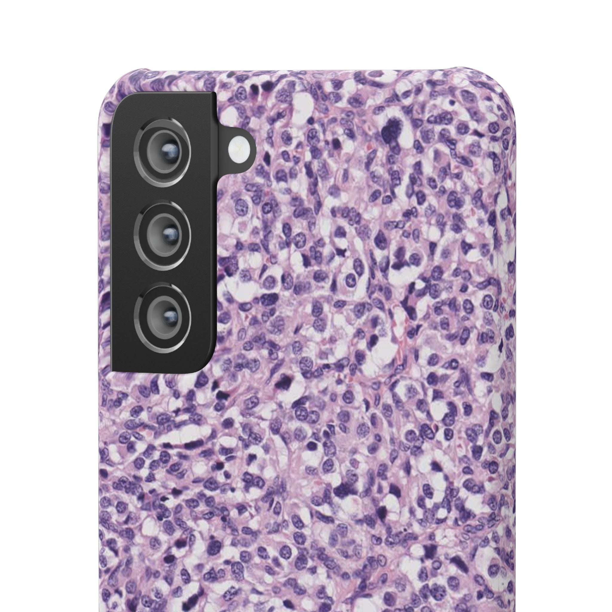 Slim Case Paraganglion