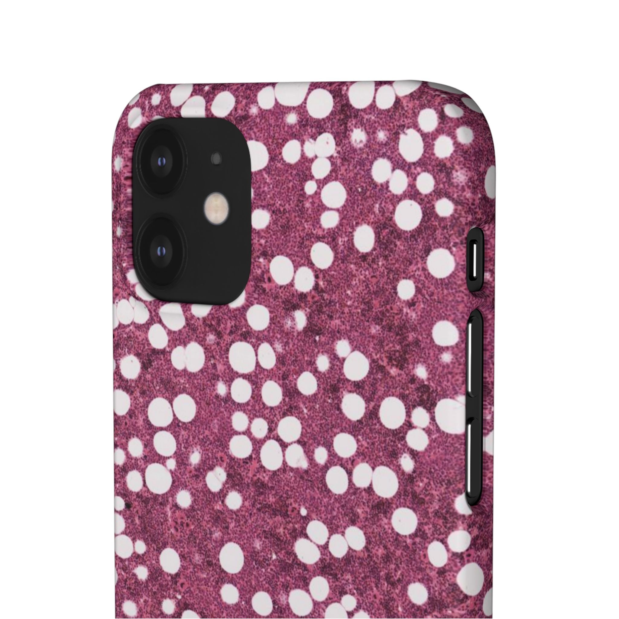 Slim Case Myelolipom