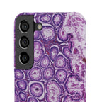 Slim Case Peutz-Jeghers Polyp
