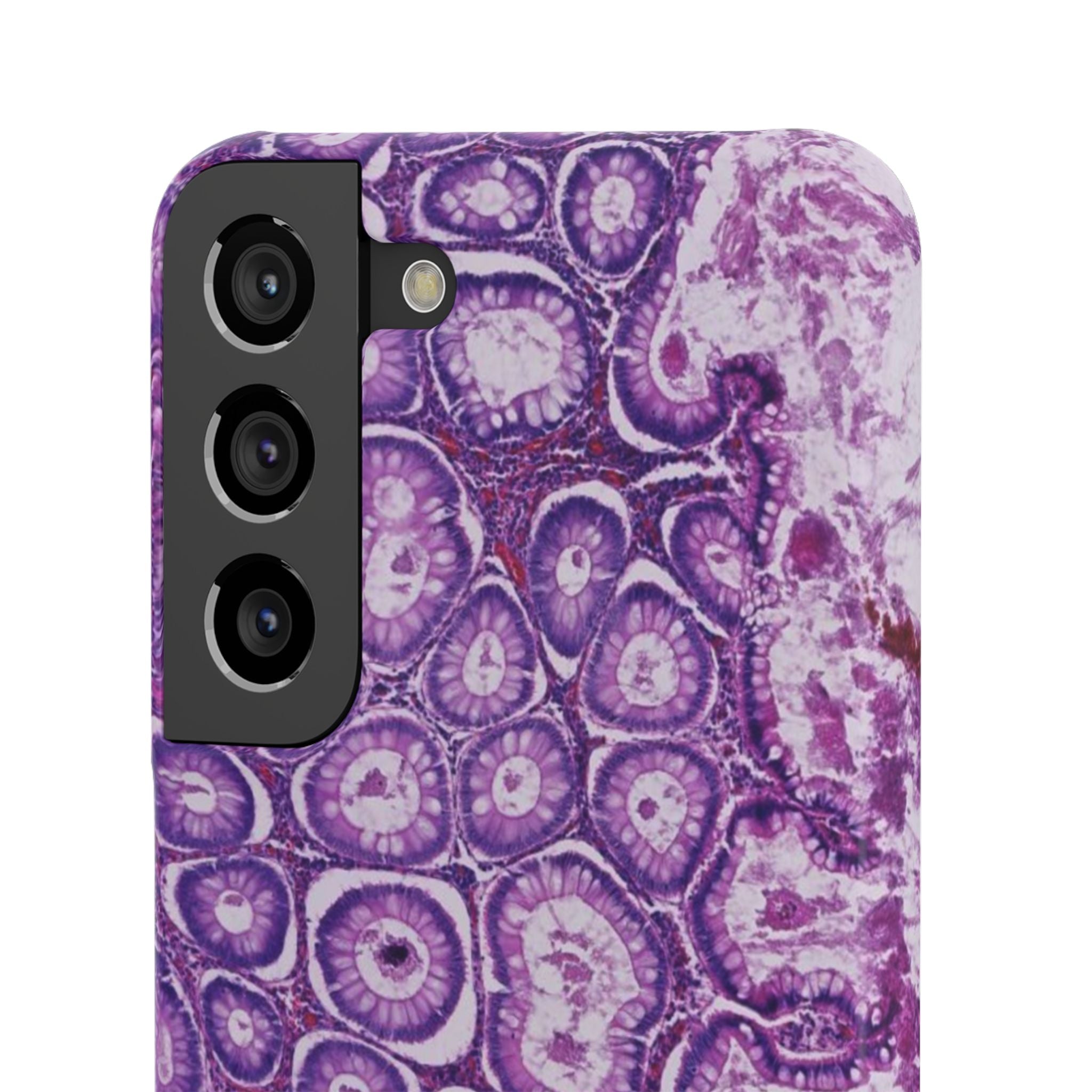 Slim Case Peutz-Jeghers Polyp