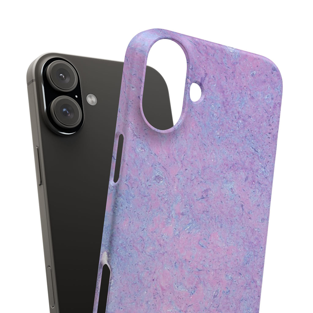Slim Case Arterielles Myxom