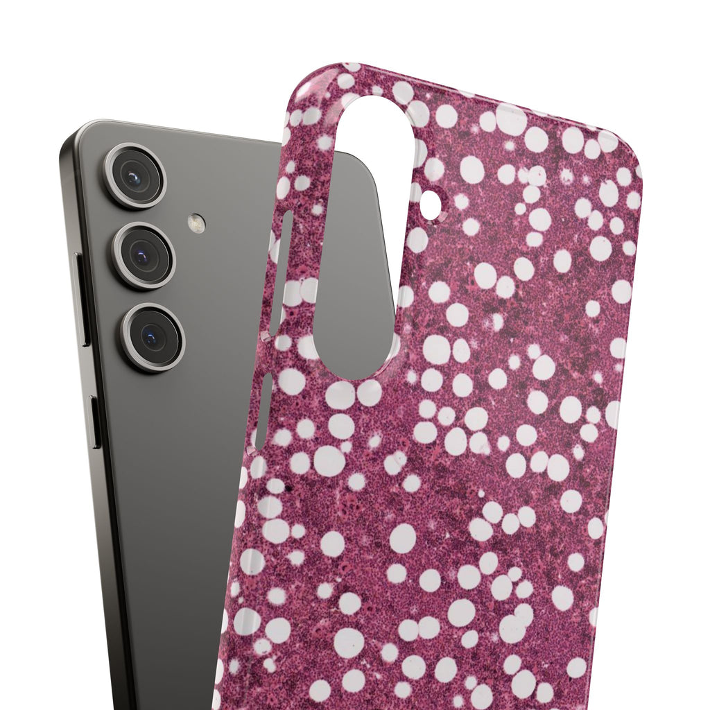 Slim Case Myelolipom