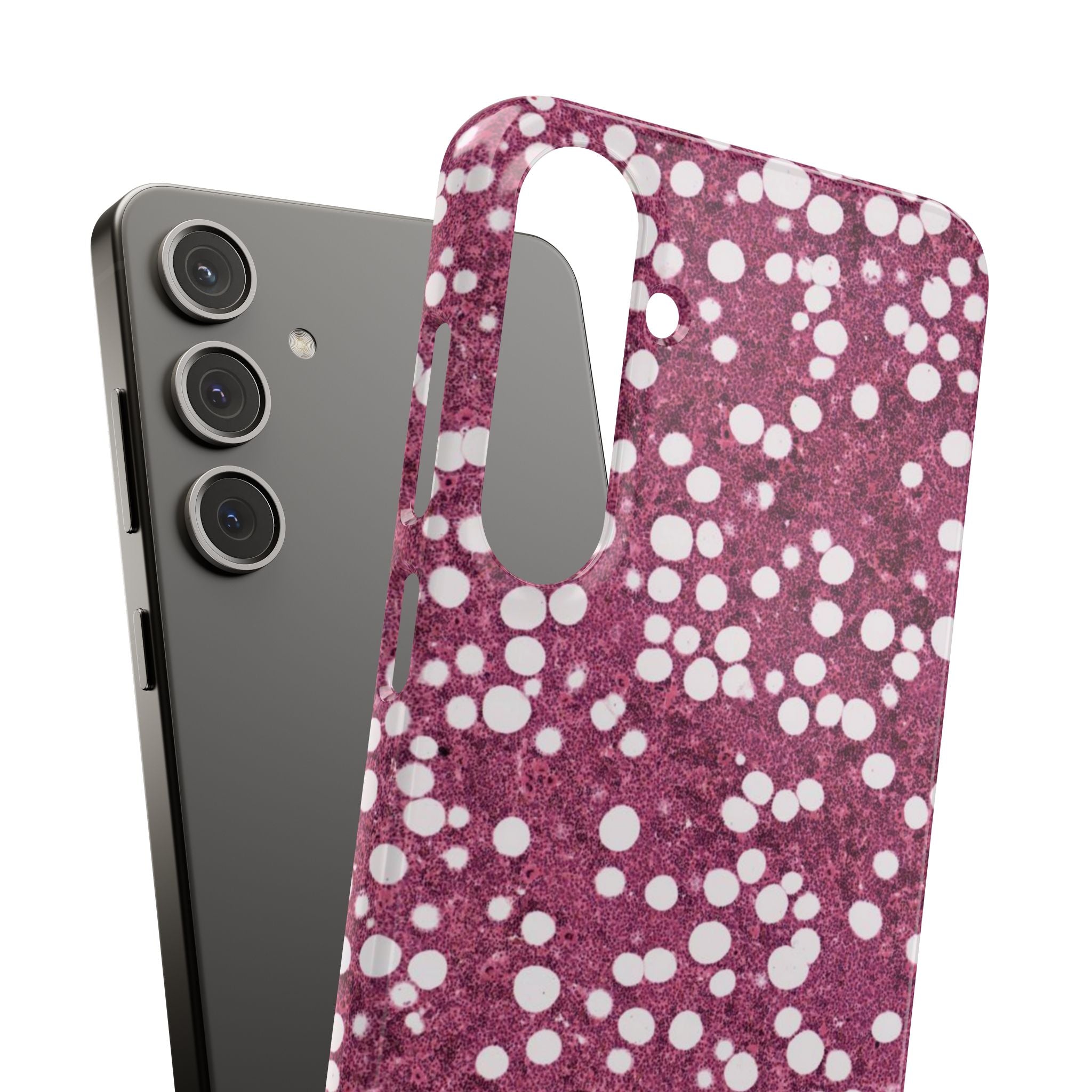 Slim Case Myelolipom