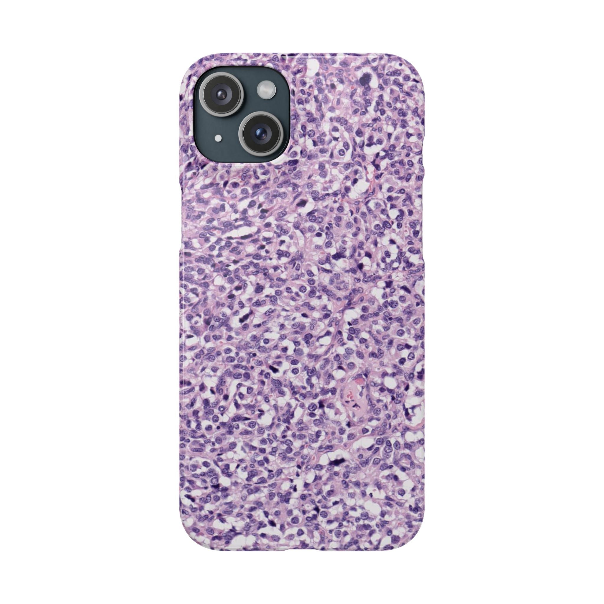 Slim Case Paraganglion