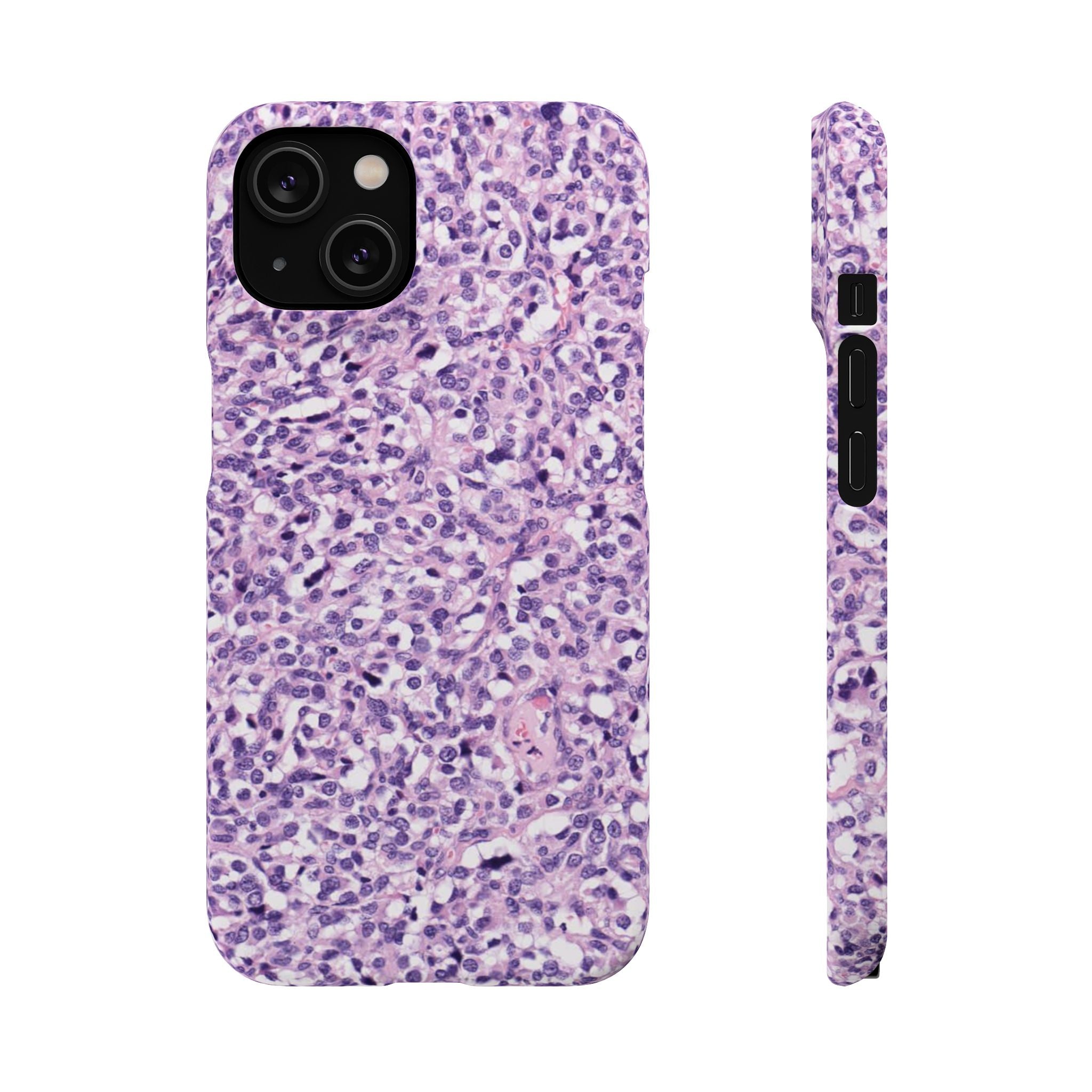 Slim Case Paraganglion