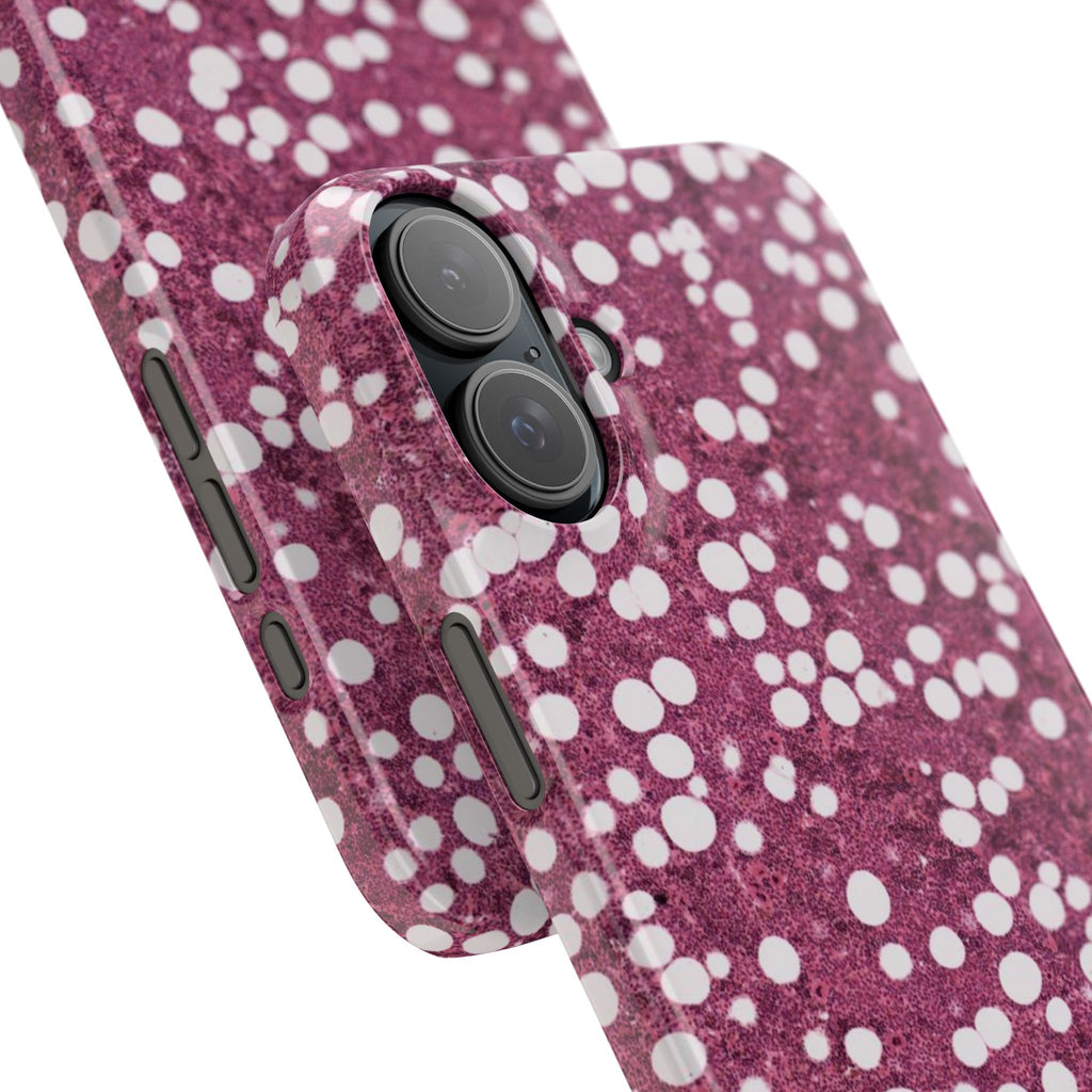 Slim Case Myelolipom