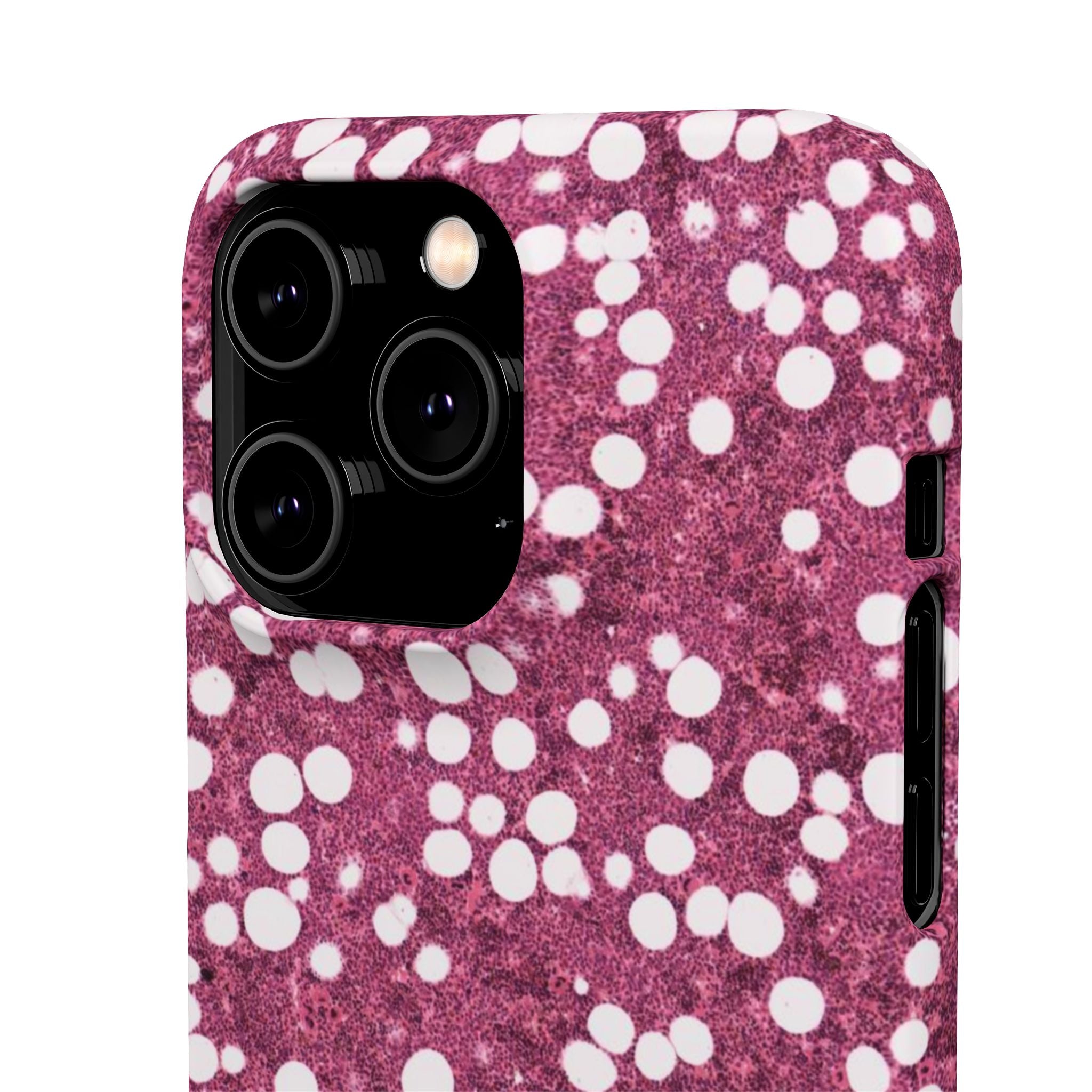 Slim Case Myelolipom