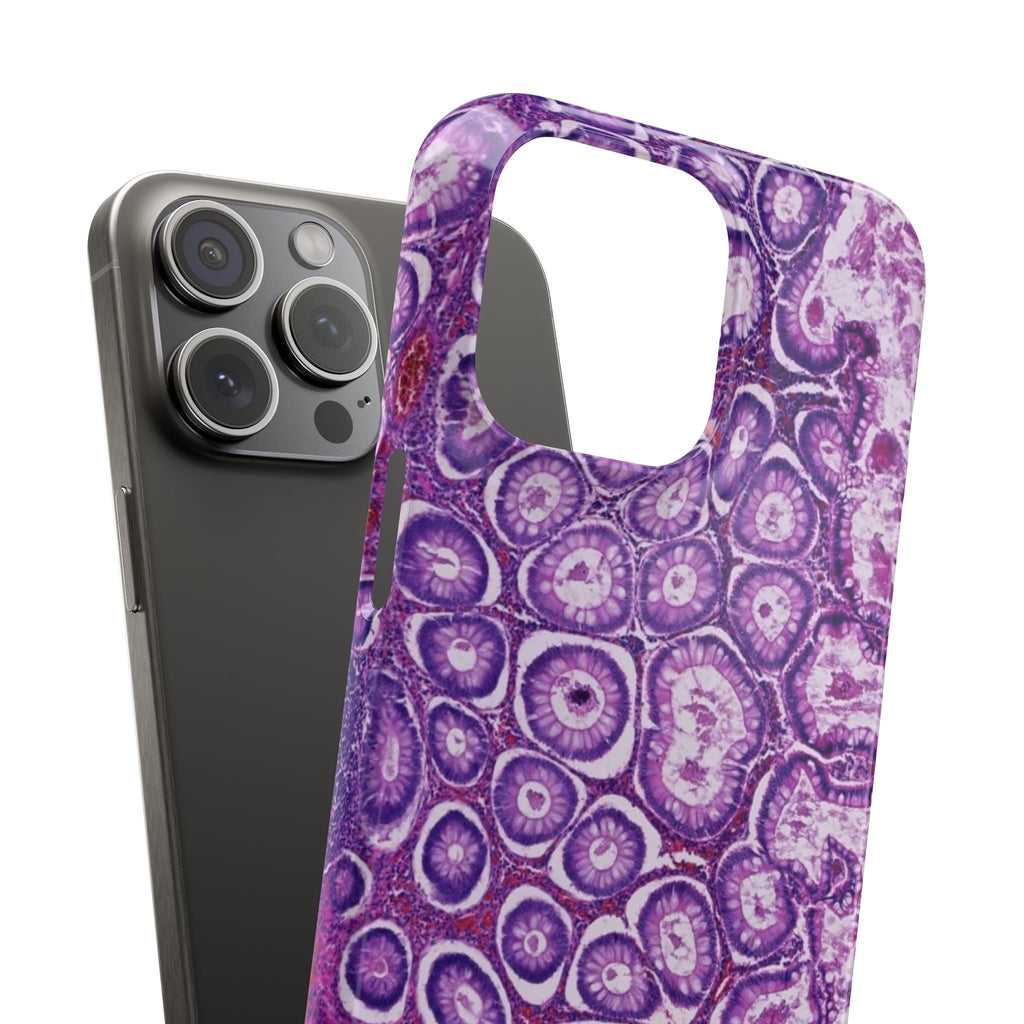 Slim Case Peutz-Jeghers Polyp