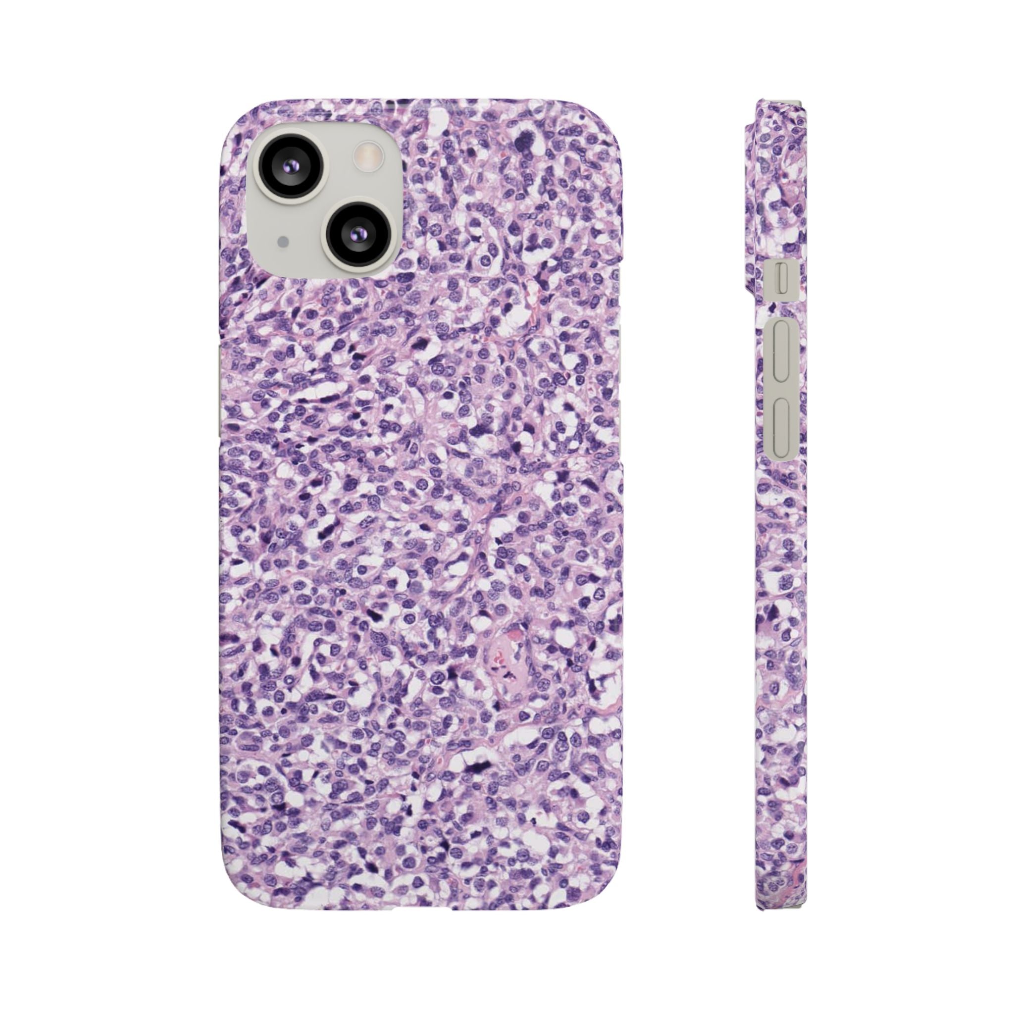Slim Case Paraganglion