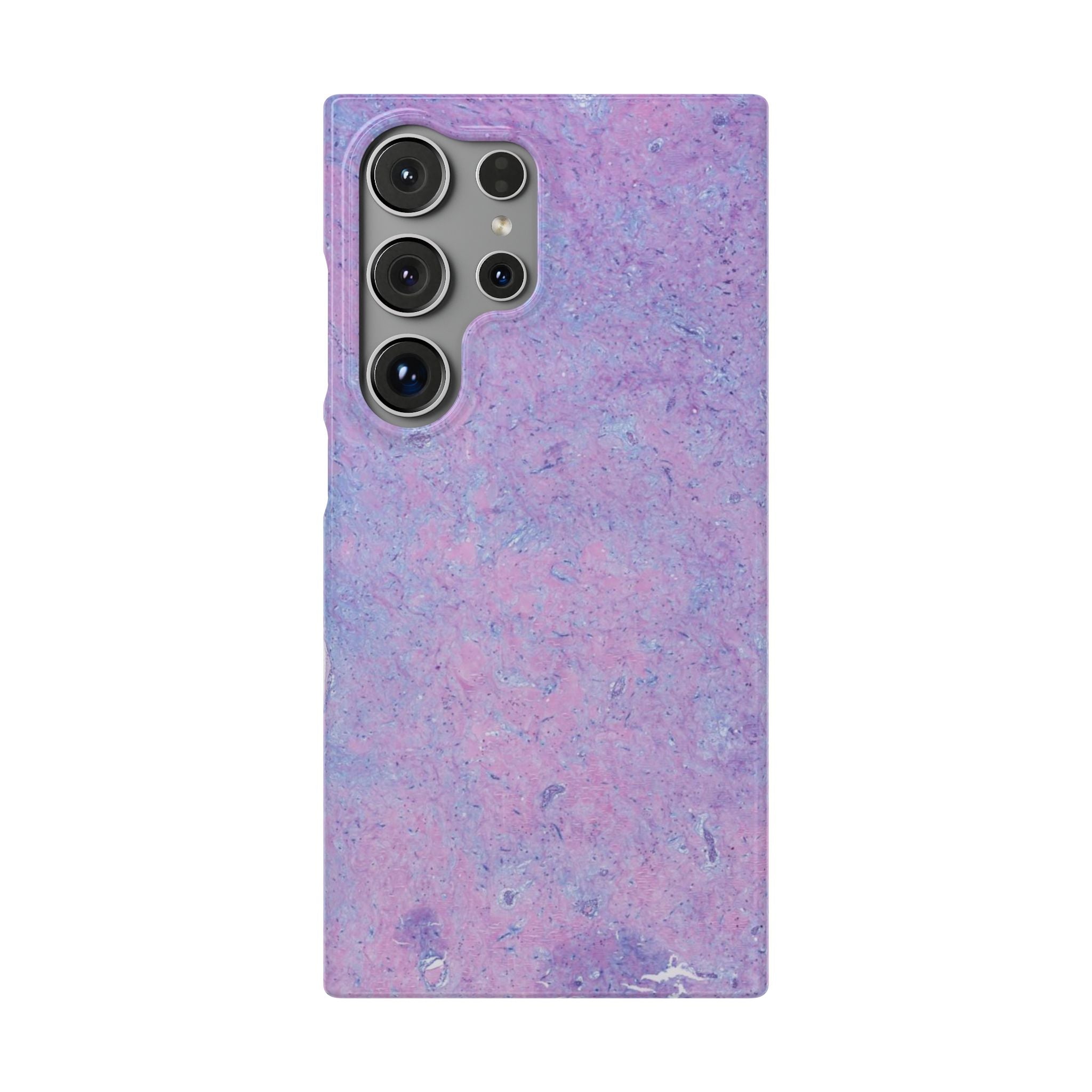 Slim Case Arterielles Myxom