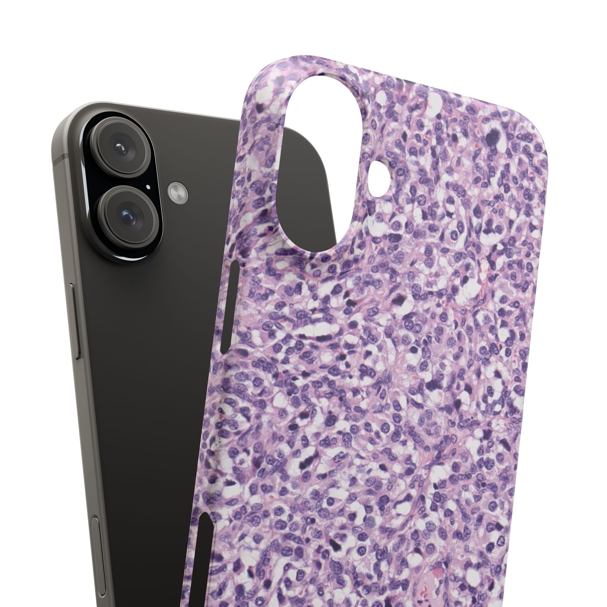 Slim Case Paraganglion