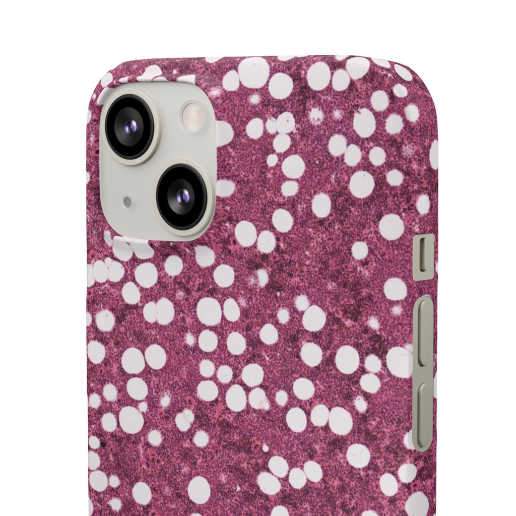 Slim Case Myelolipom