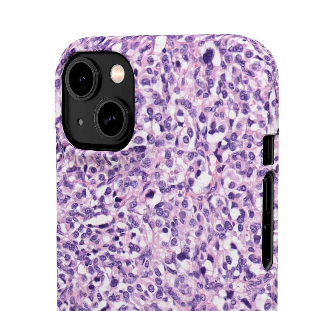 Slim Case Paraganglion