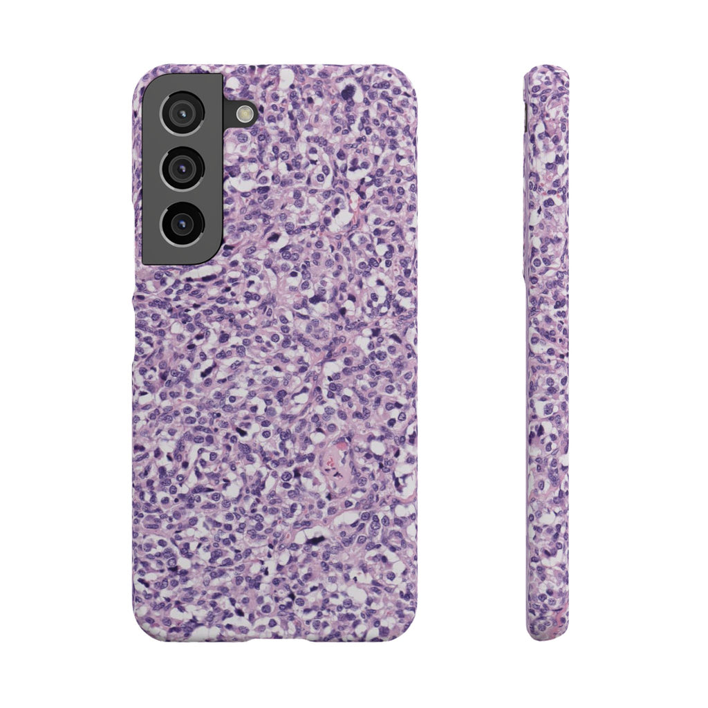 Slim Case Paraganglion