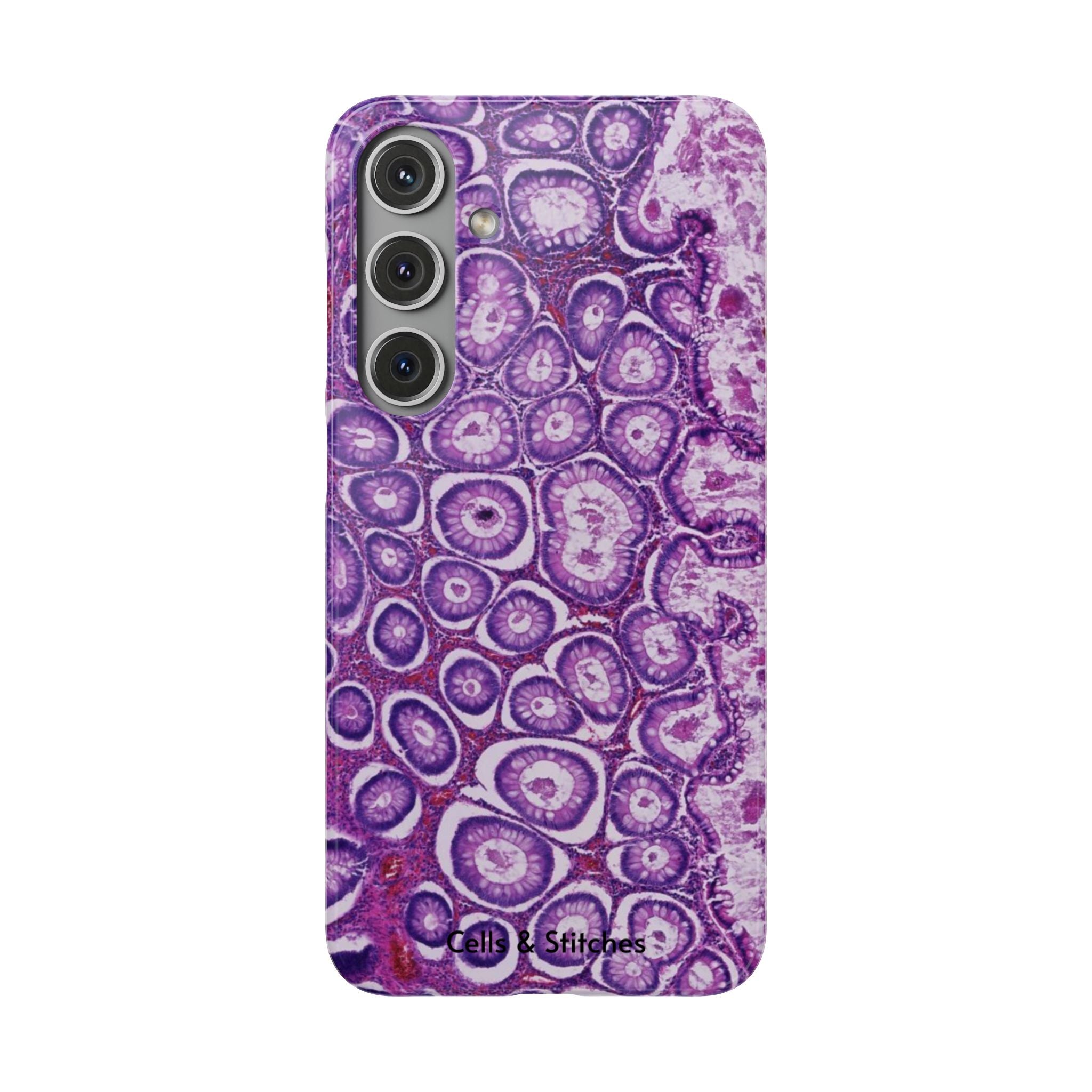Slim Case Peutz-Jeghers Polyp