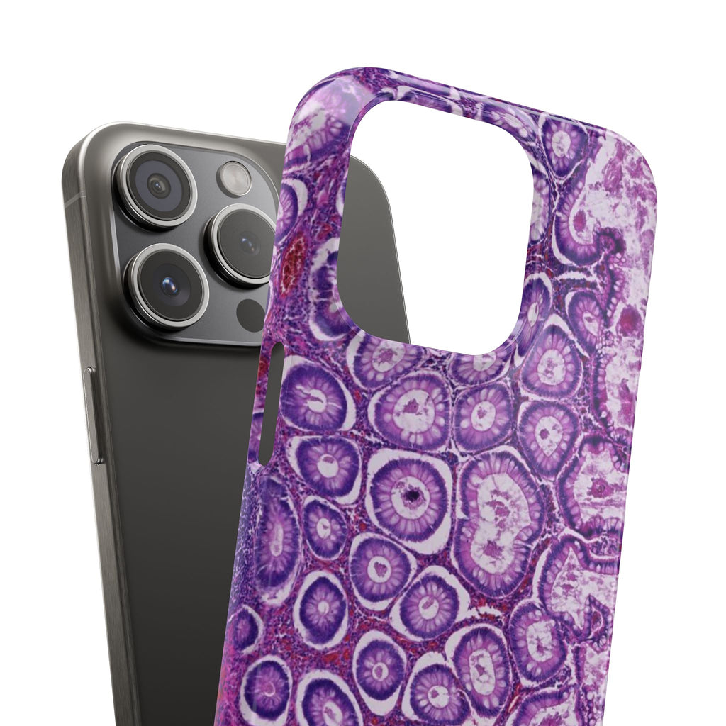 Slim Case Peutz-Jeghers Polyp