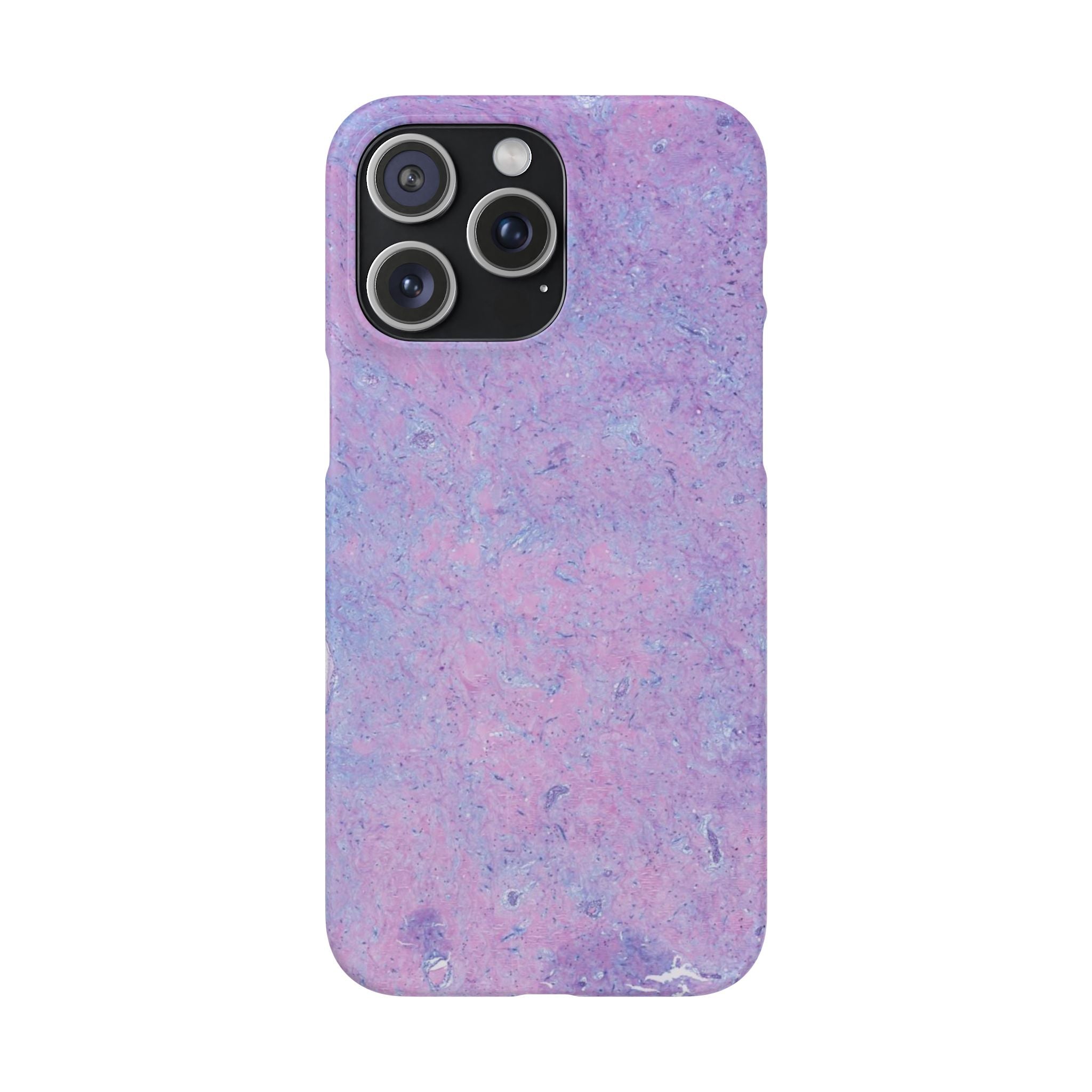 Slim Case Arterielles Myxom