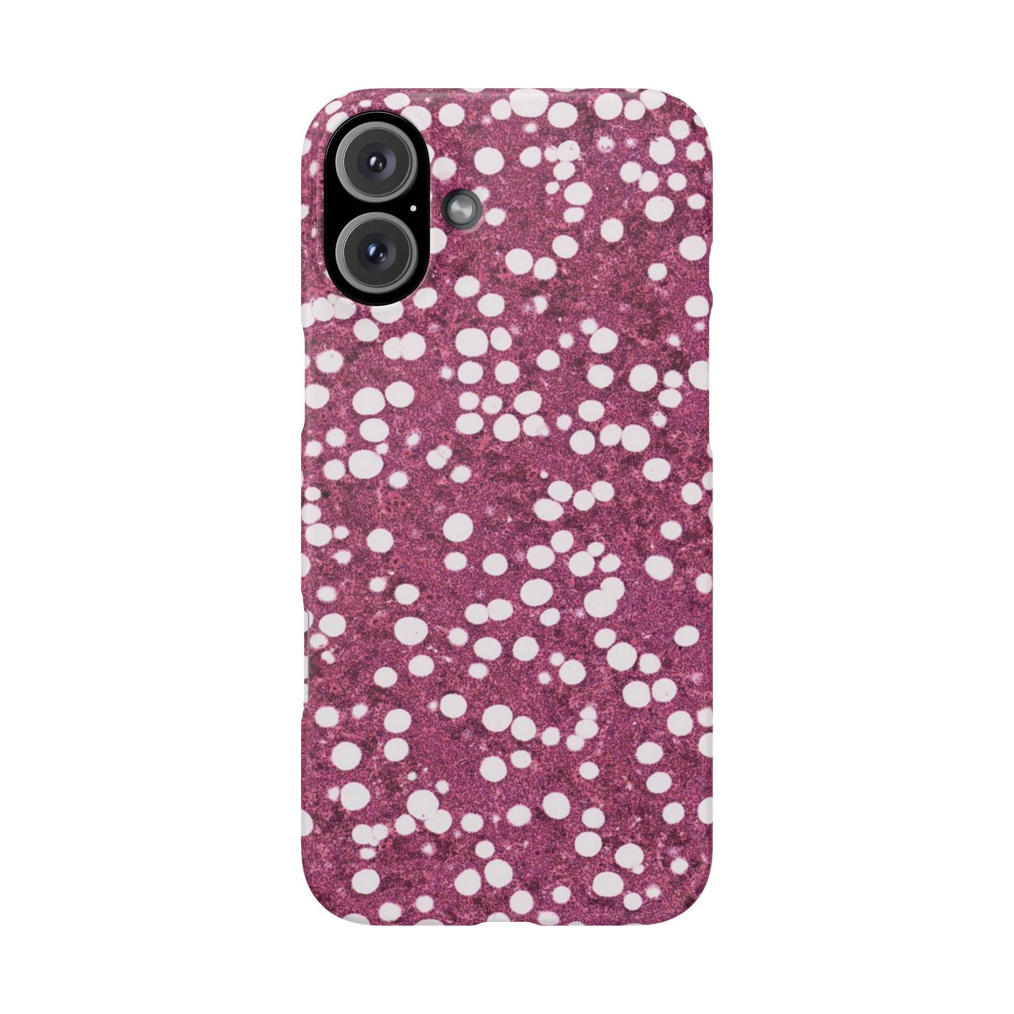 Slim Case Myelolipom