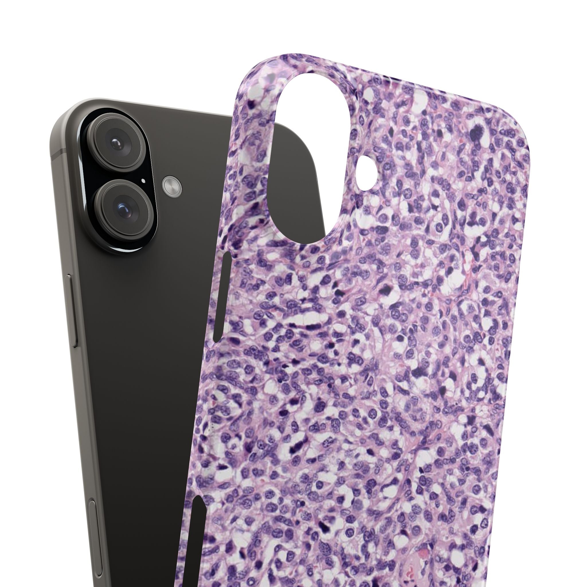 Slim Case Paraganglion