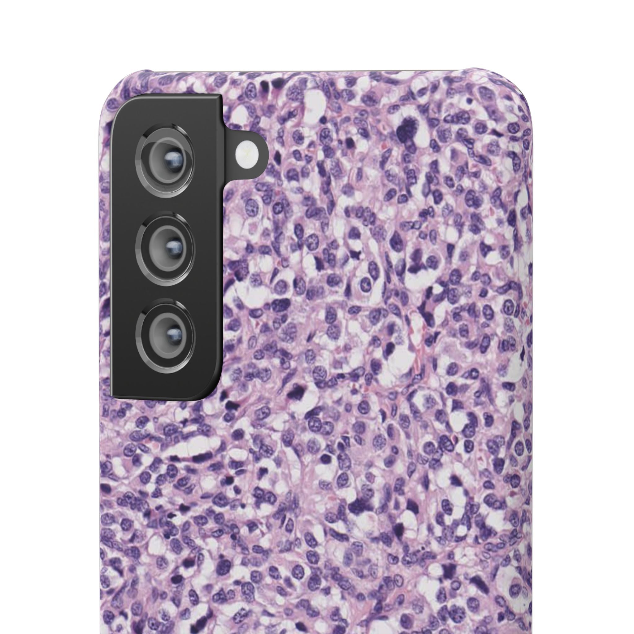 Slim Case Paraganglion