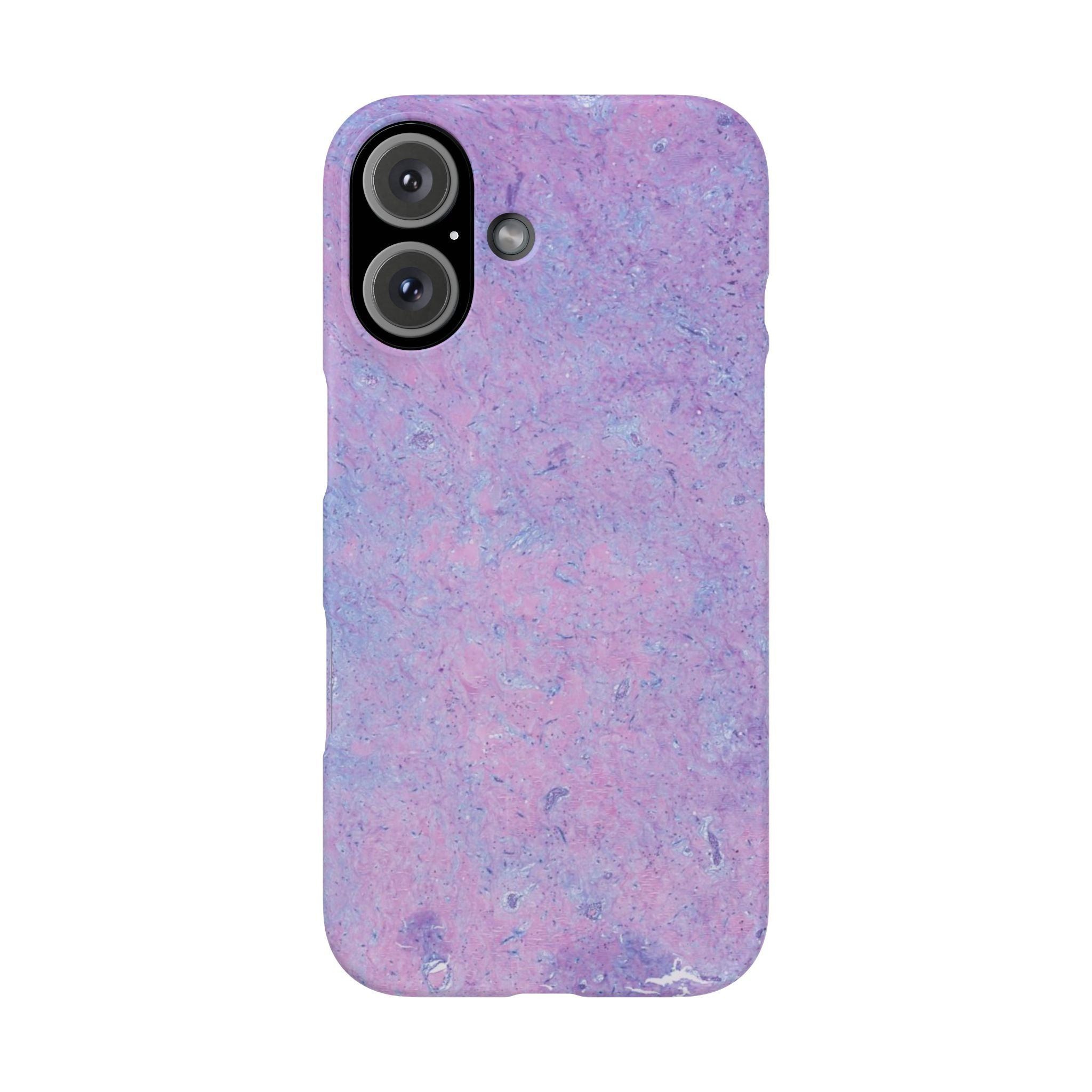 Slim Case Arterielles Myxom