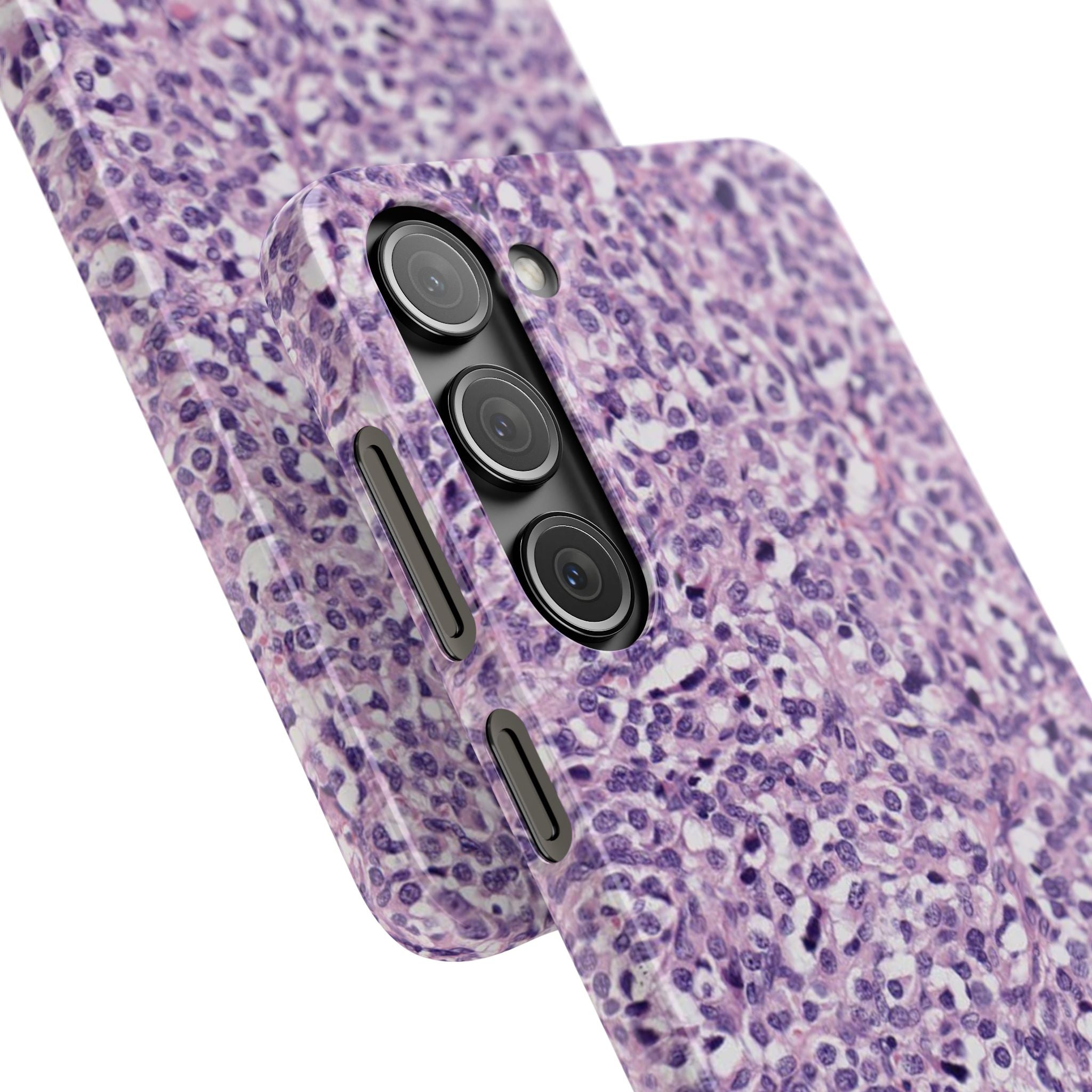 Slim Case Paraganglion
