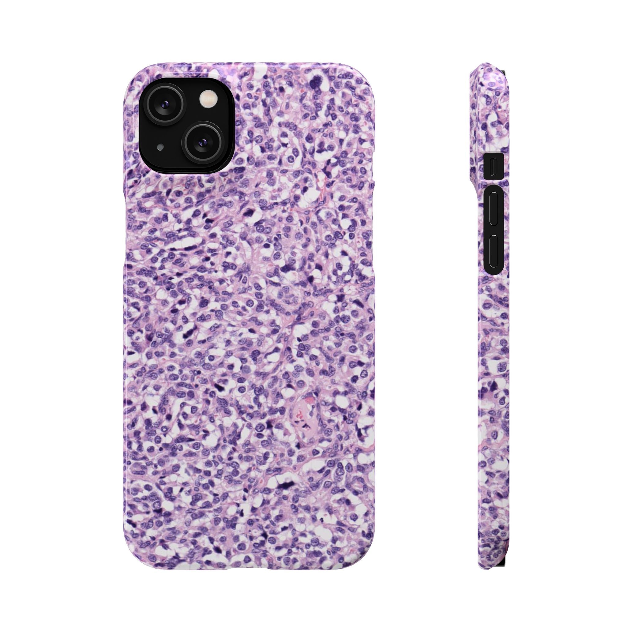 Slim Case Paraganglion