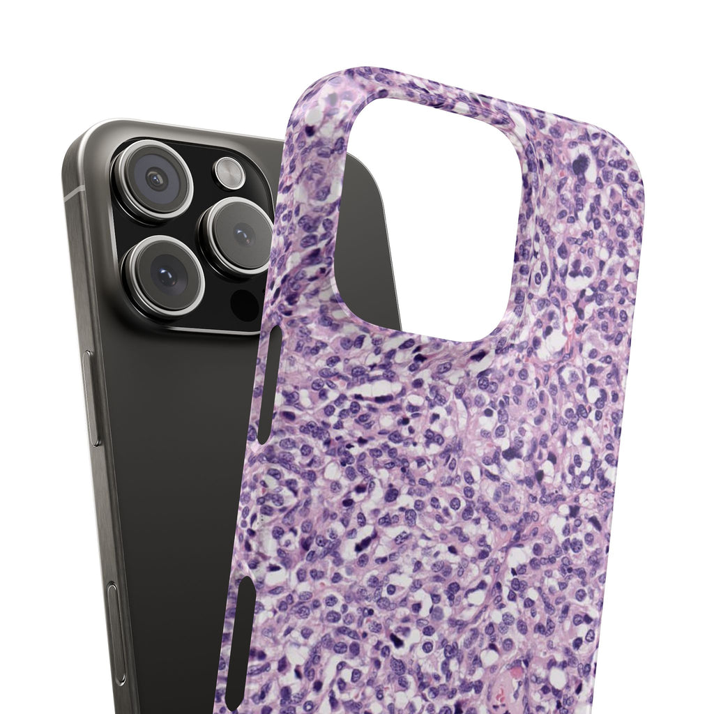 Slim Case Paraganglion