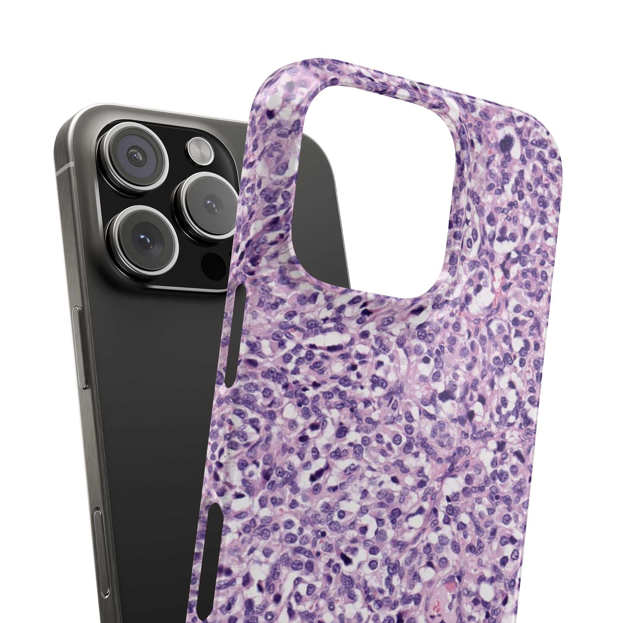 Slim Case Paraganglion
