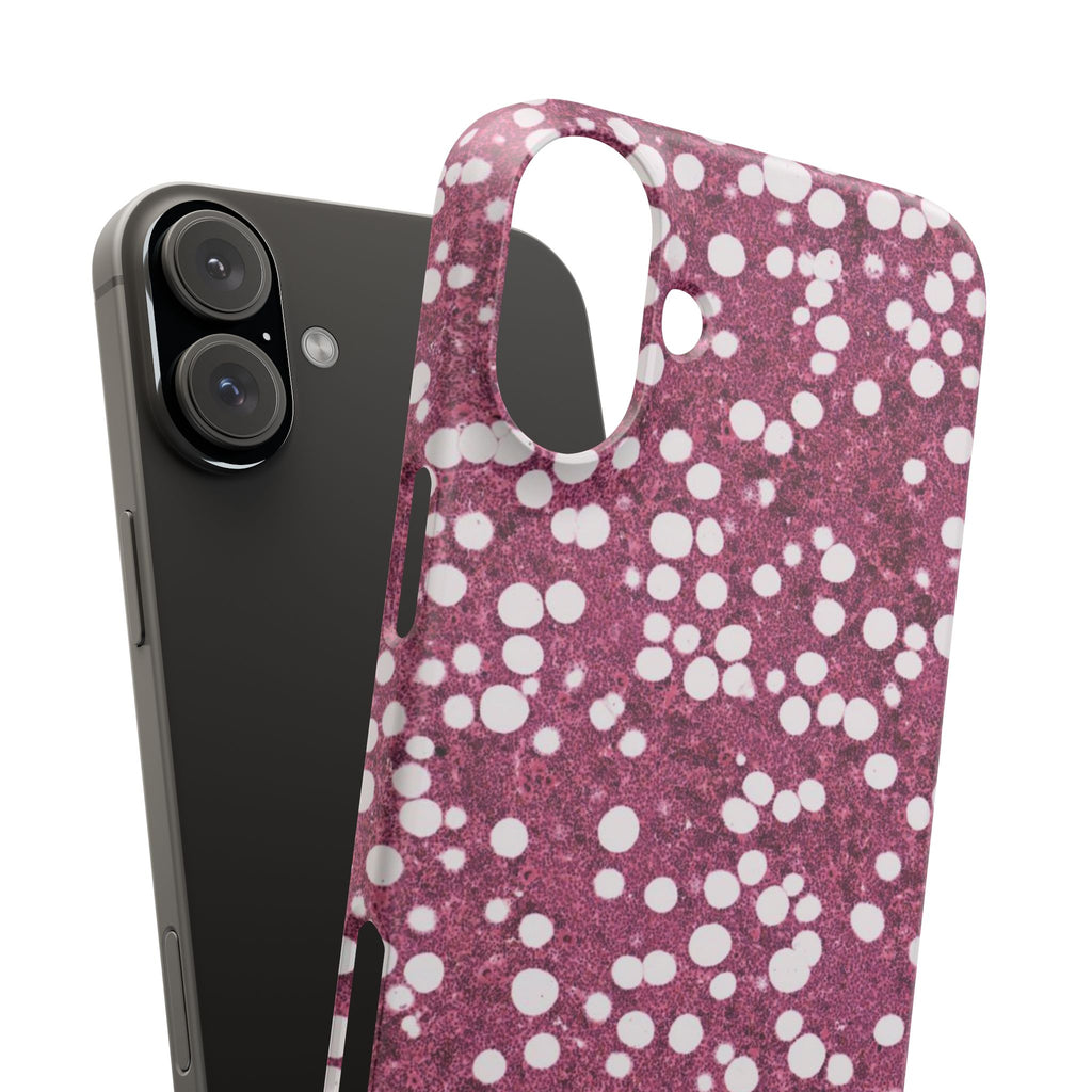 Slim Case Myelolipom