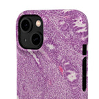Slim Case Endometrium
